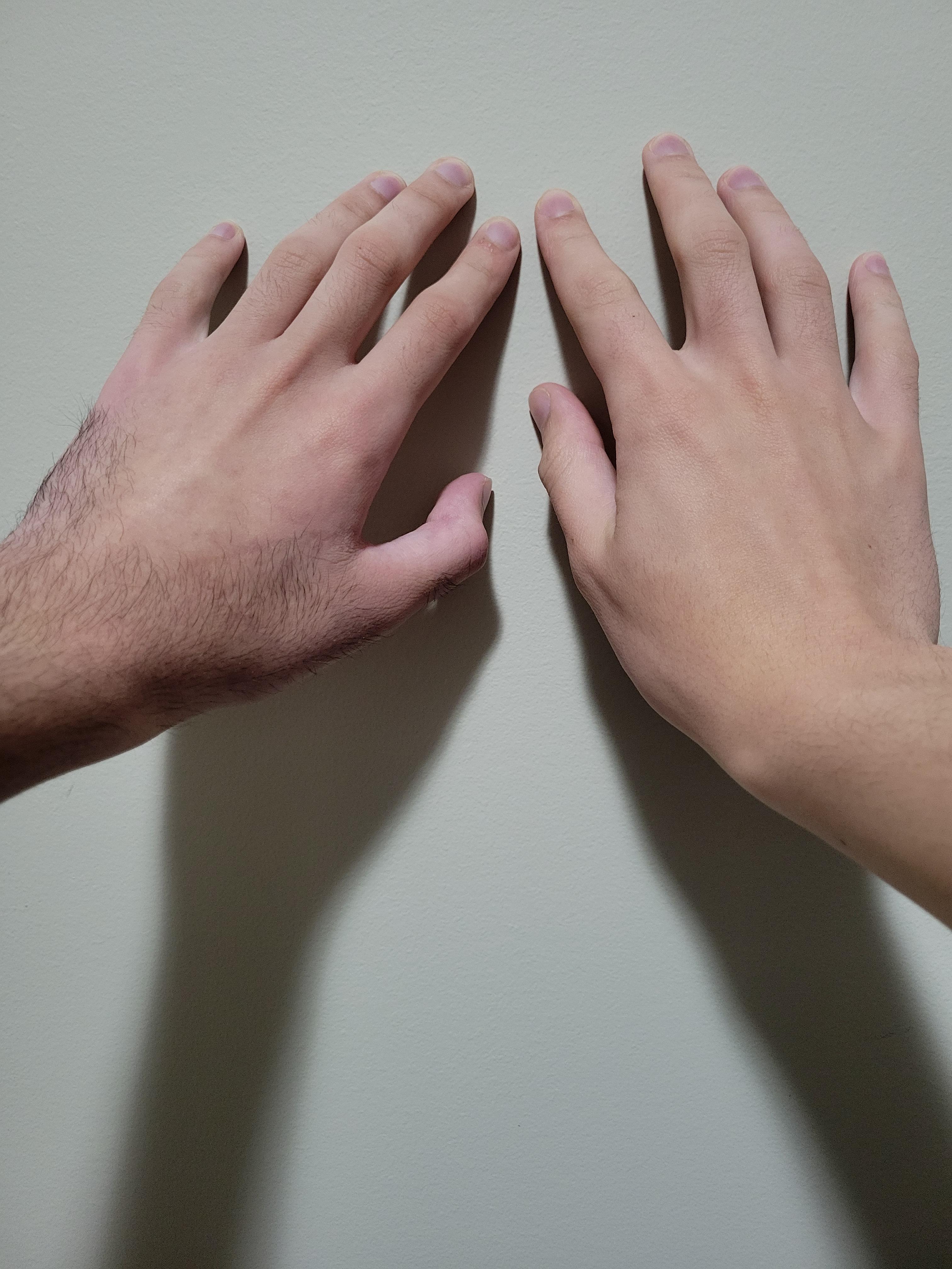 The hair on my arm which my cast was removed from has grown a lot more