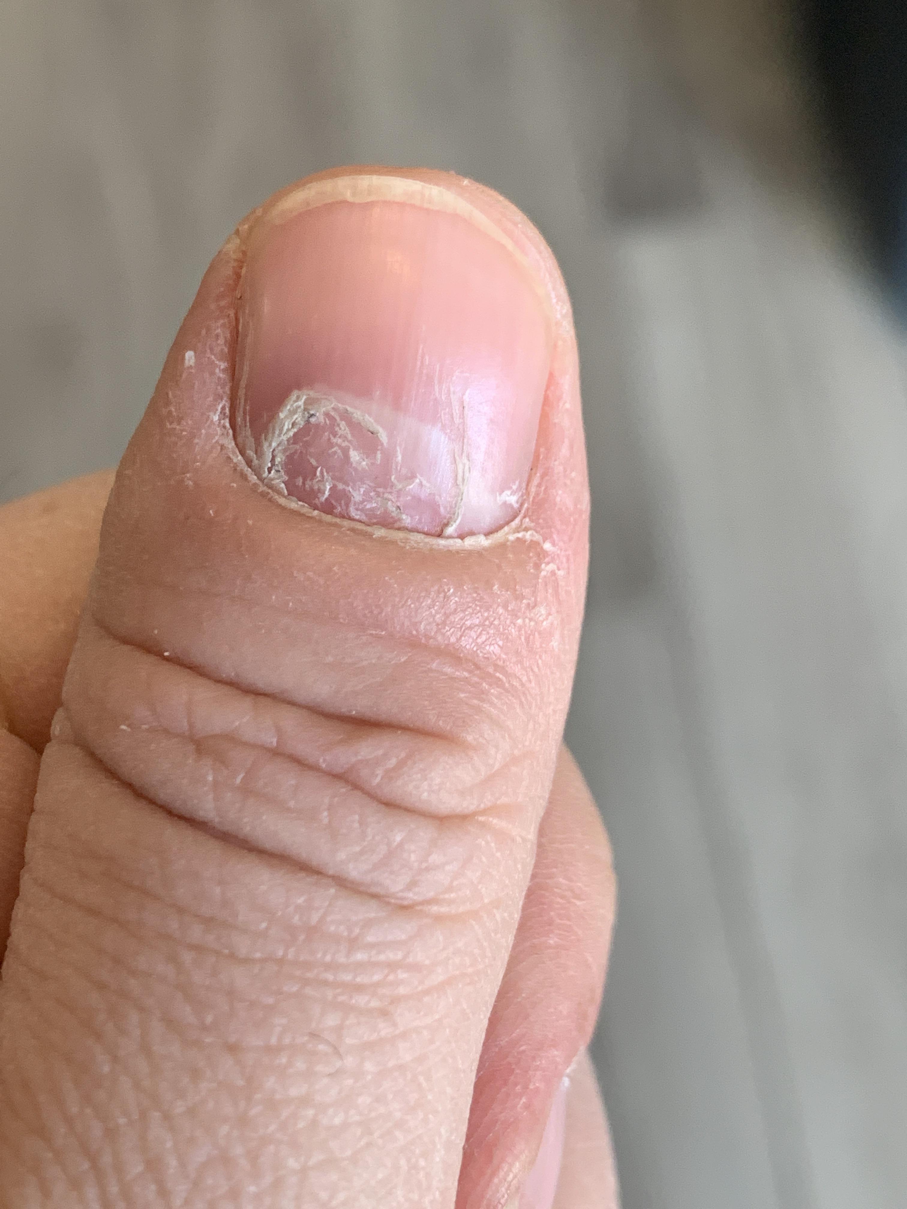 Why is my nail growing out weird? r/medical