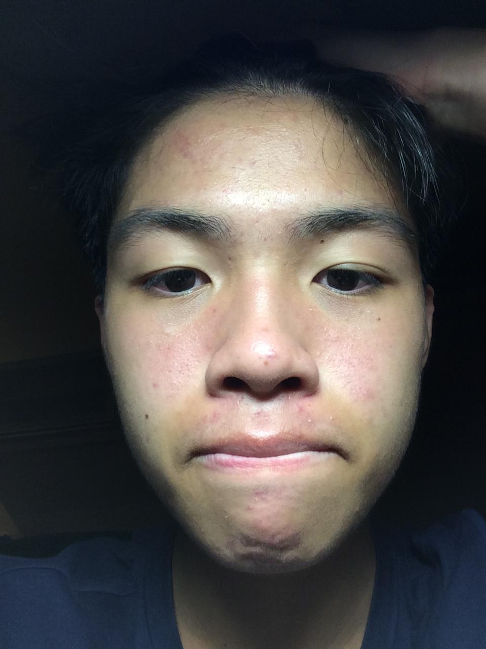 [Acne] Oily, sensitive skin. What should i do to get rid of the