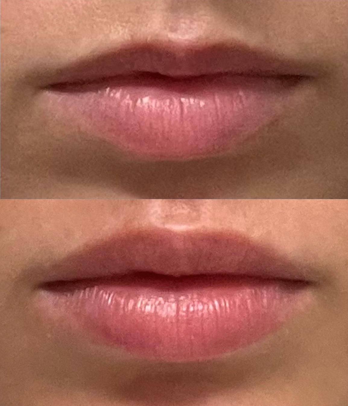 Fat grafting to the lips before & after r/PlasticSurgery
