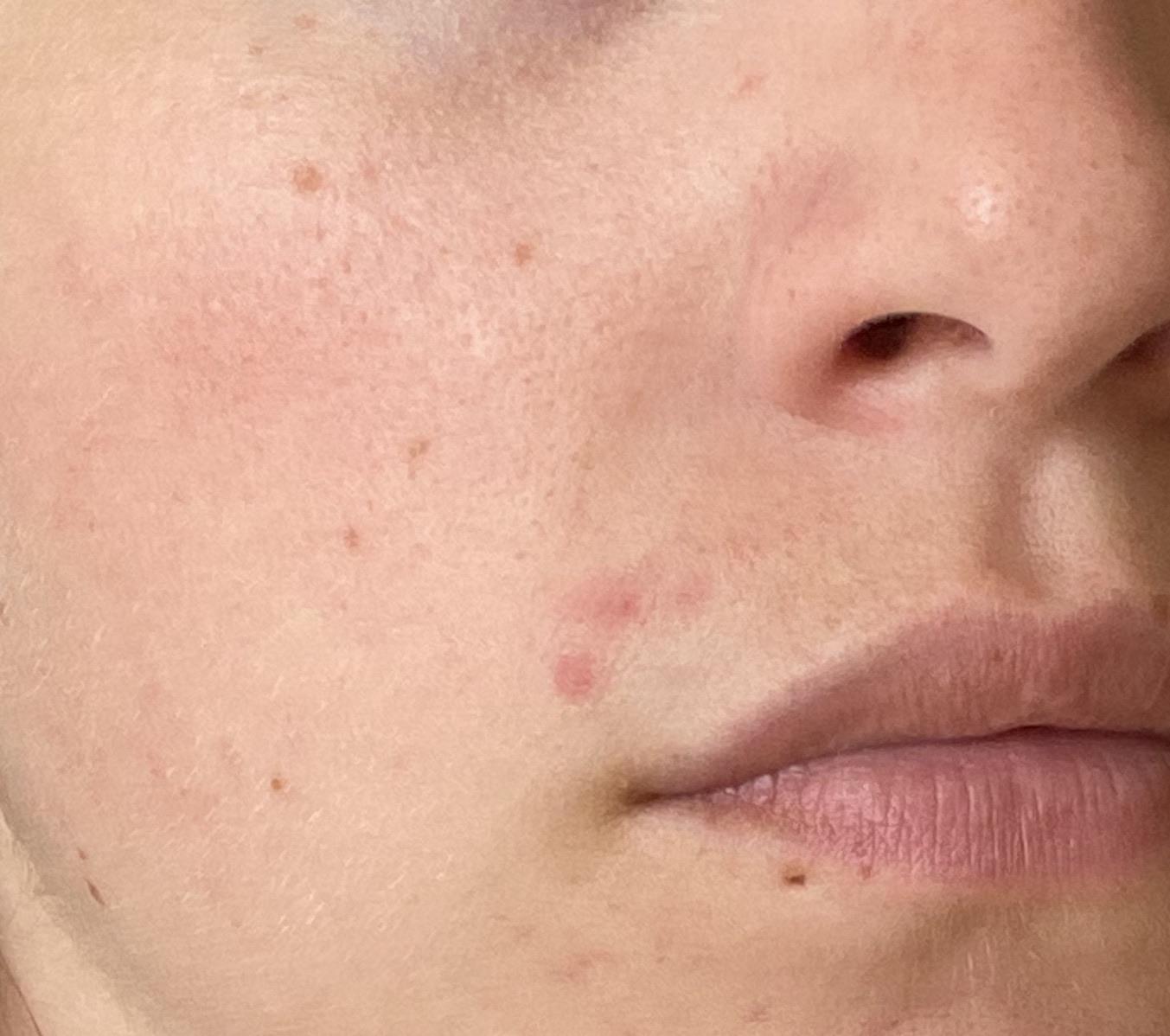 Why do I keep getting pimples in the exact same spot? [Skin Concern] r/SkincareAddiction