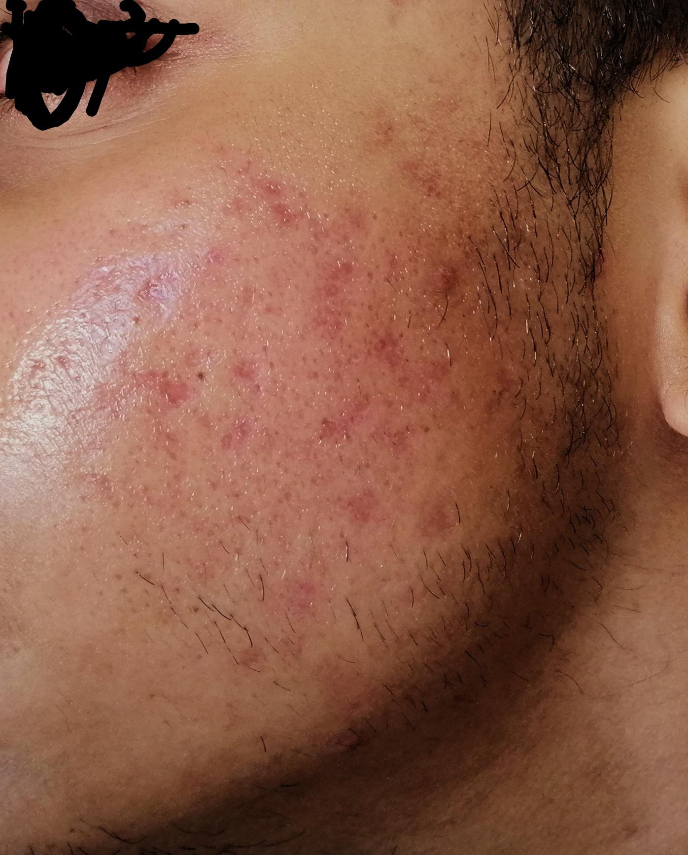 How do i treat these discoloration left behind. I have many scars left from cystic acne. I am