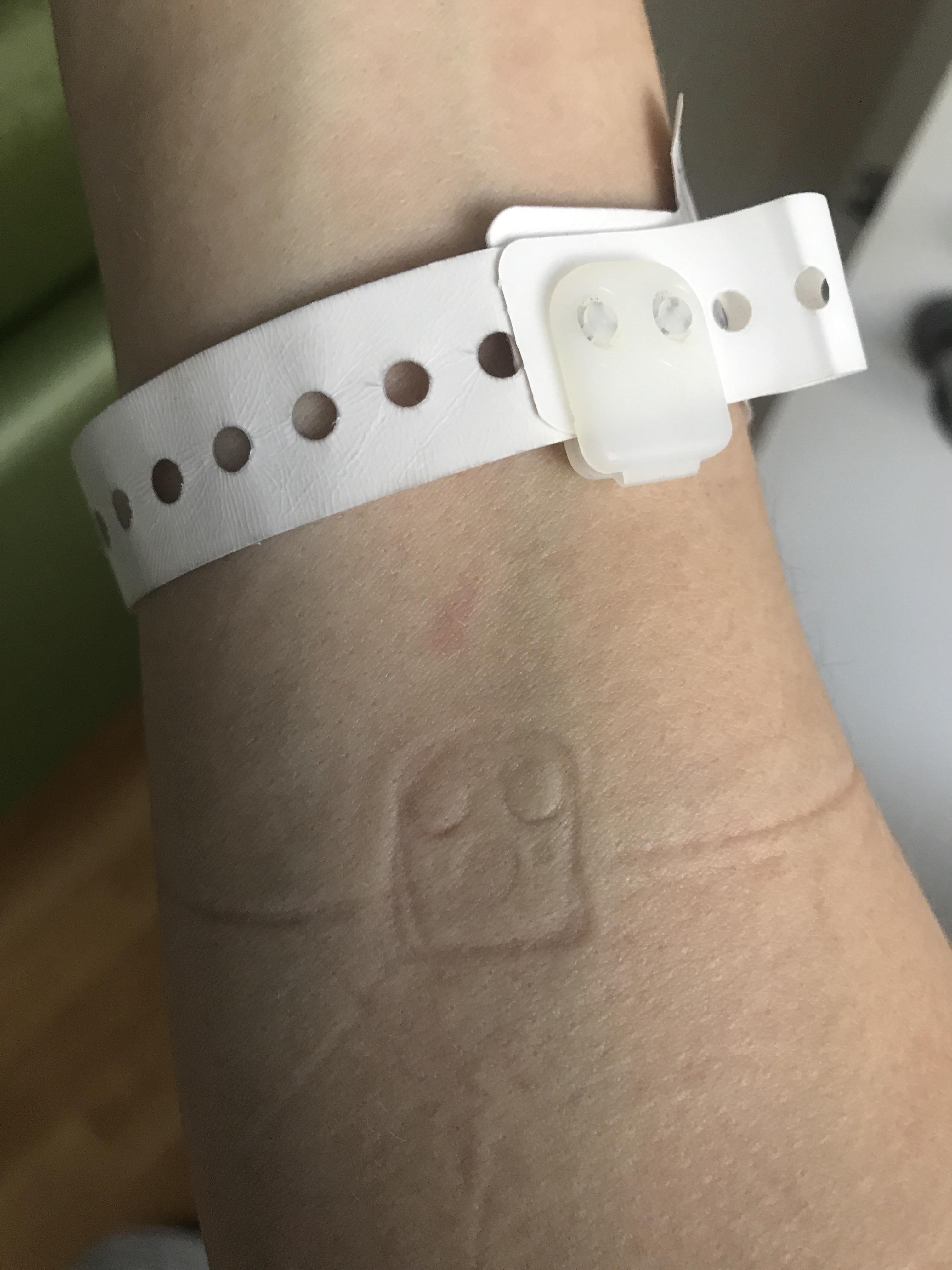 The imprint from my hospital band r/mildlyinteresting