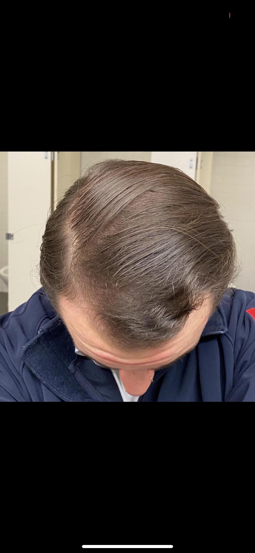 Saunas are beneficial or bad for hair regrowth tressless