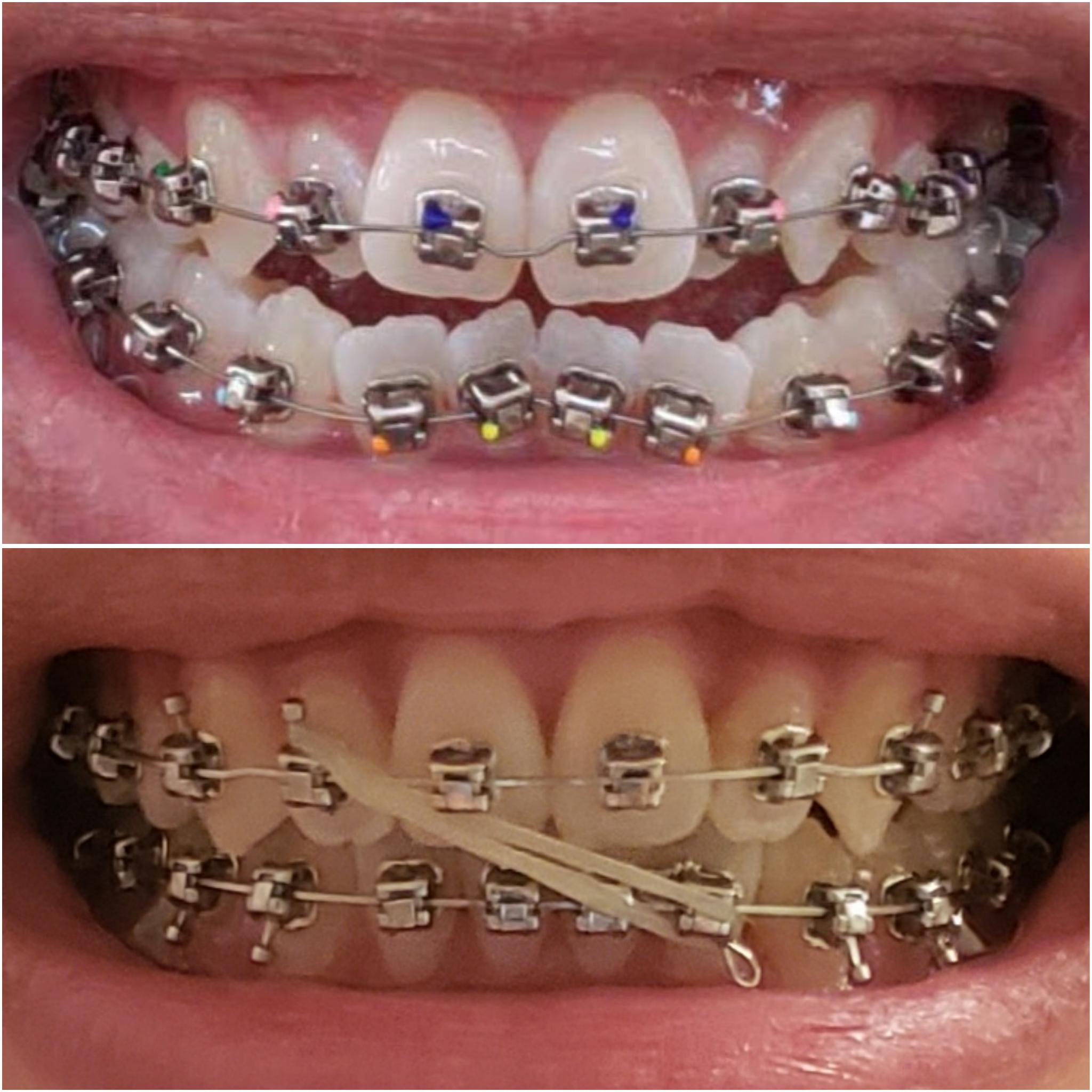 One Year with Damon Braces r/braces