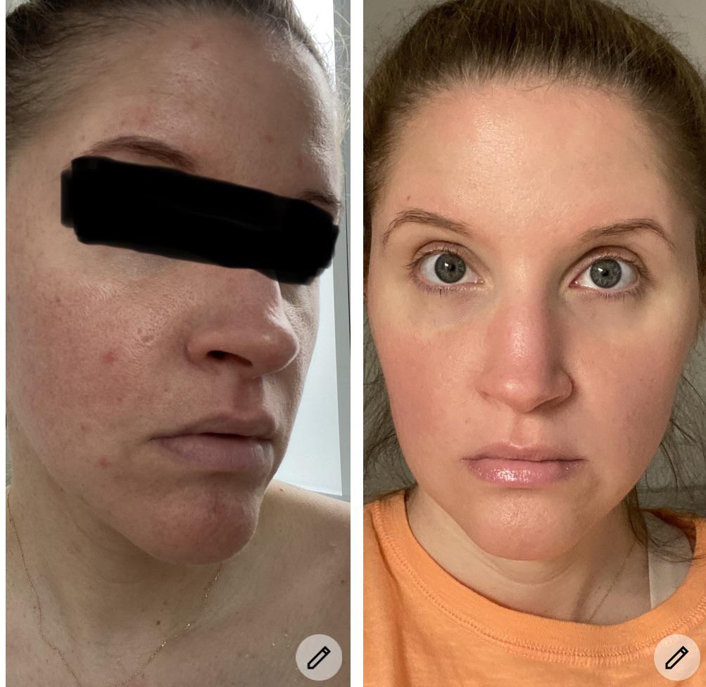 Before and After Accutane r/Accutane