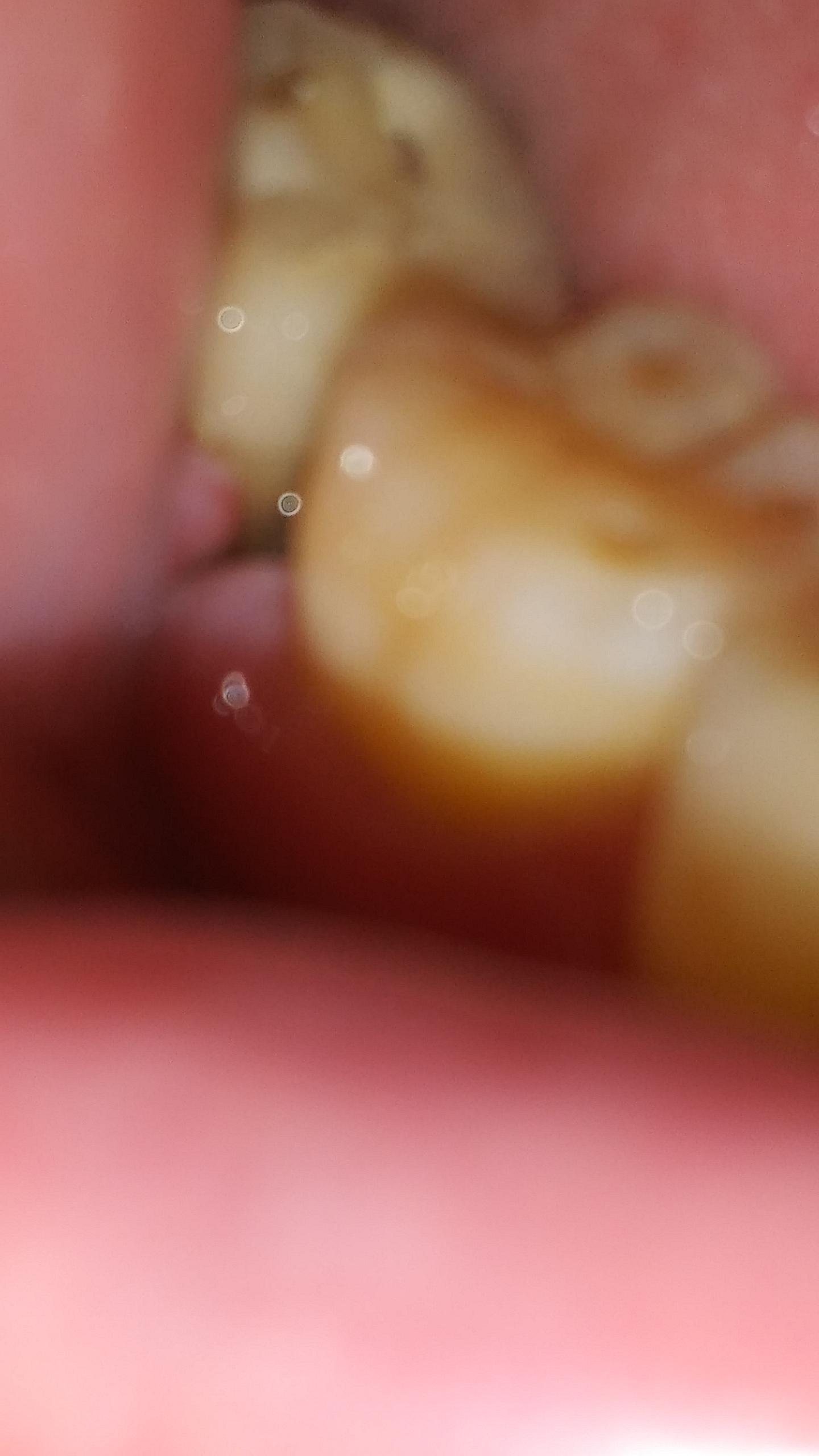 10 days Post root canal. Have bone loss. Think gum/bone graft necessary