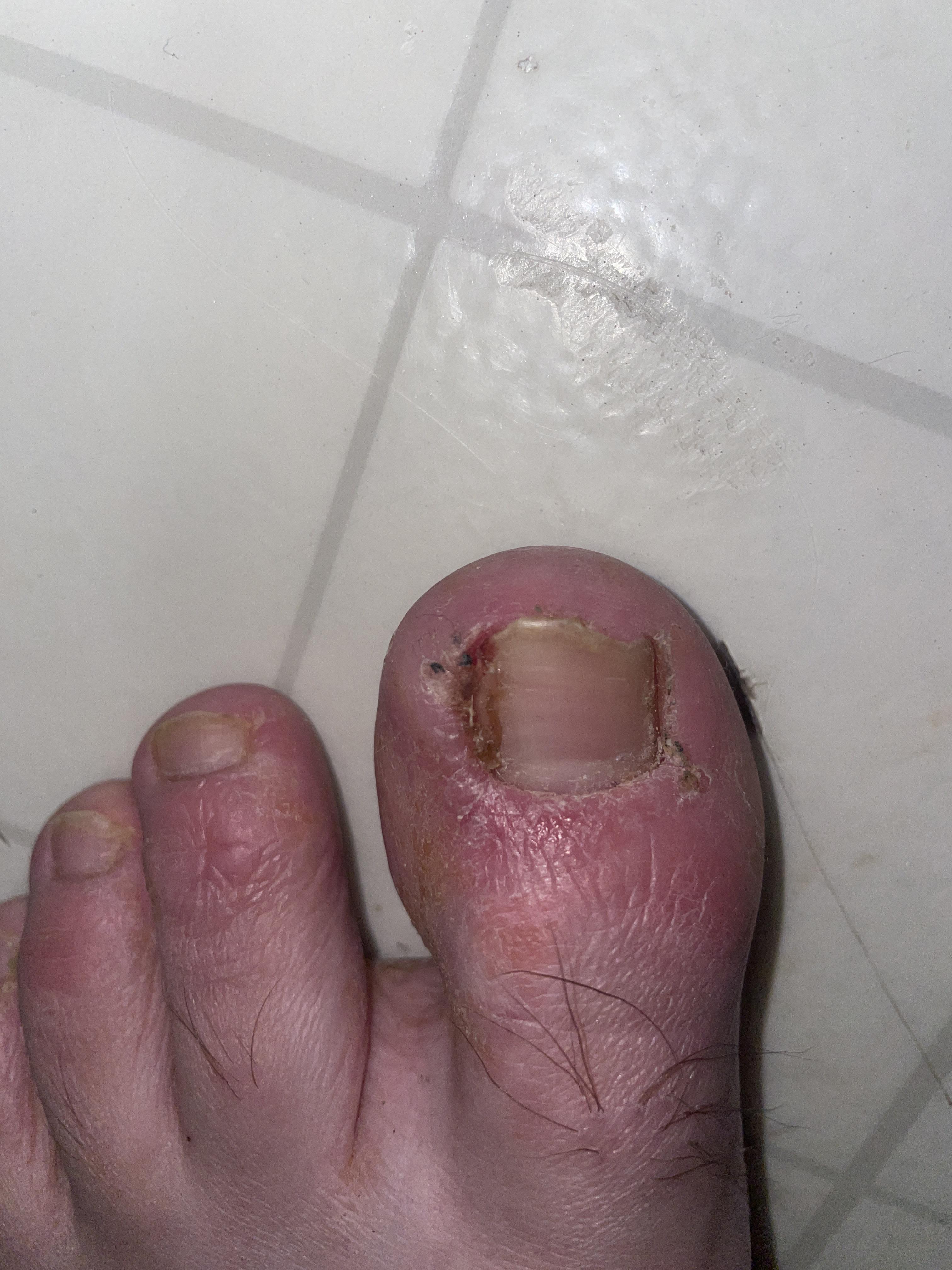 Help (I know my toes are gross, I have eczema on my feet) r/DiagnoseMe