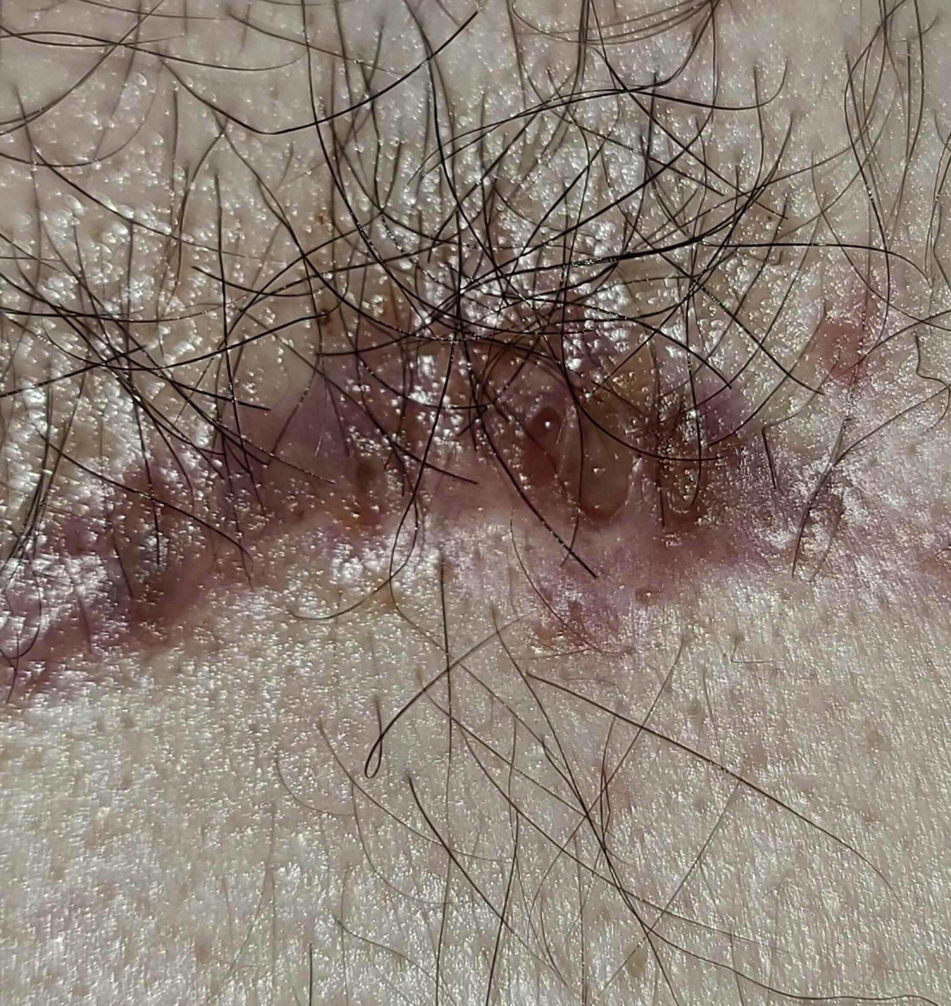 Middle incision wound taking longer to heal and getting bigger since last week. I carry my