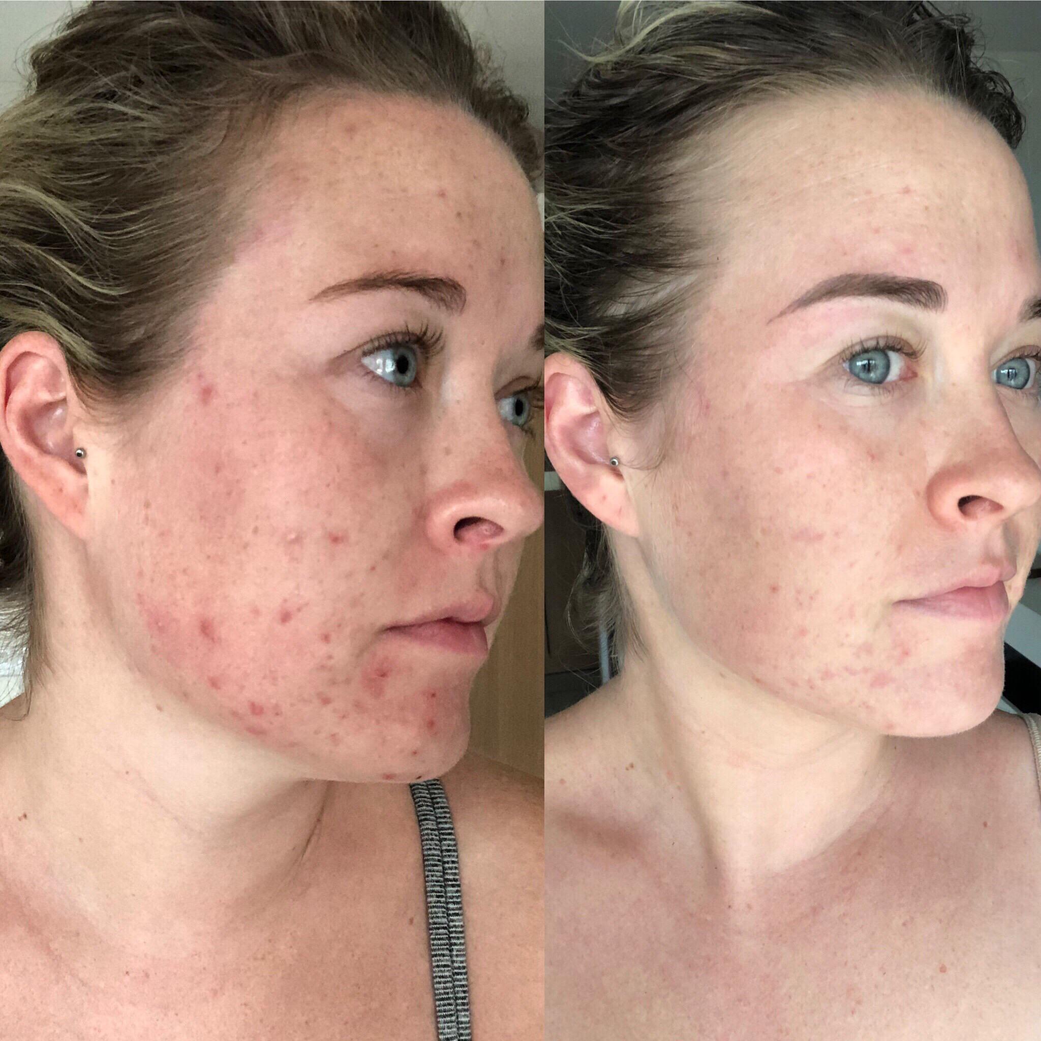 [b&a/selfie] food plan matters y'all! whole30 on my skin (no