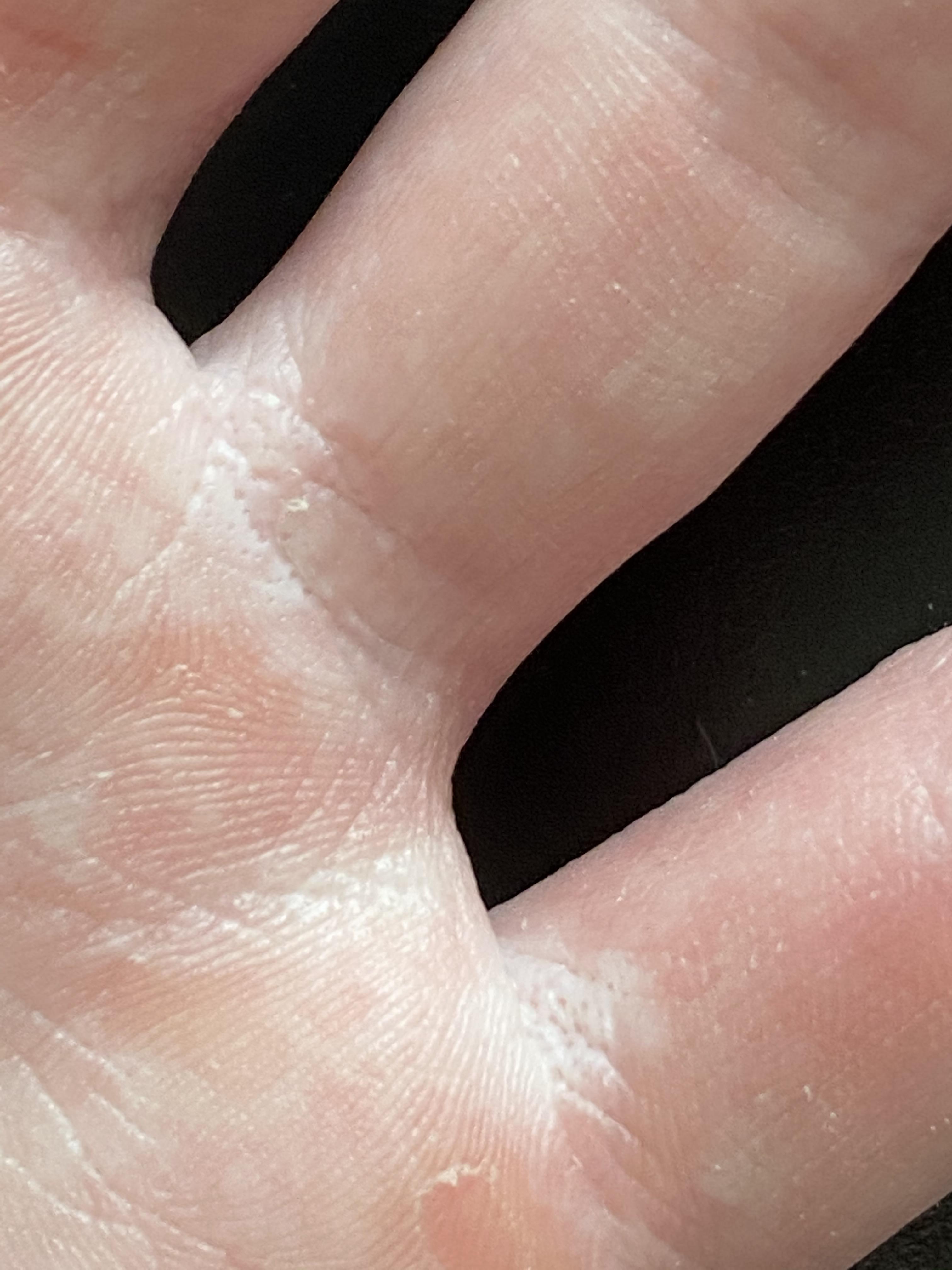 Itchy Palms Whats The Cause