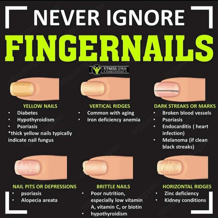 57 Vertical Lines On Nails Vitamin Deficiency Misaucun