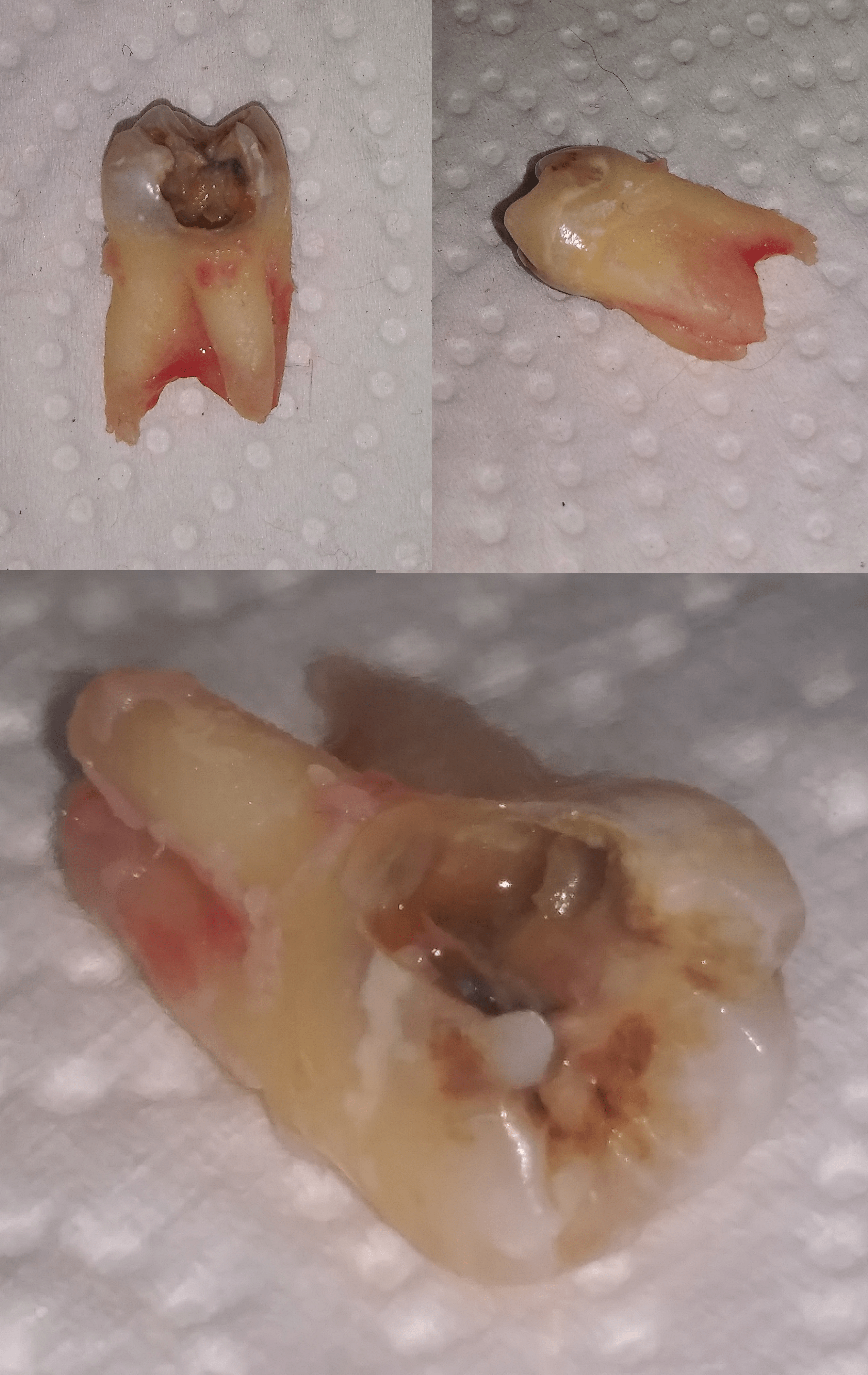 After a lifetime of enamel deficiency and dry mouth complications from