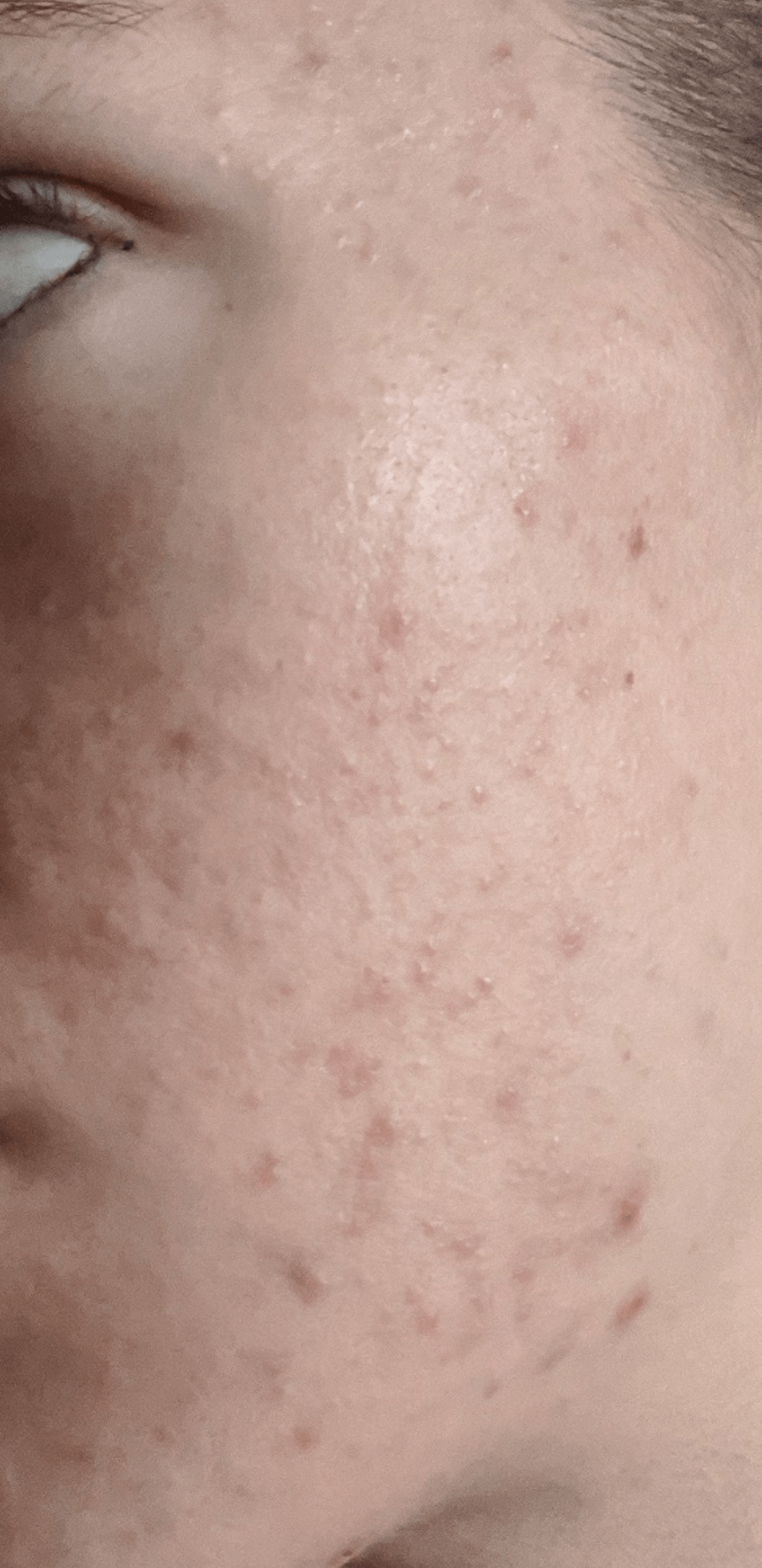 Acne or something else? Sudden change in skin texture and breakouts