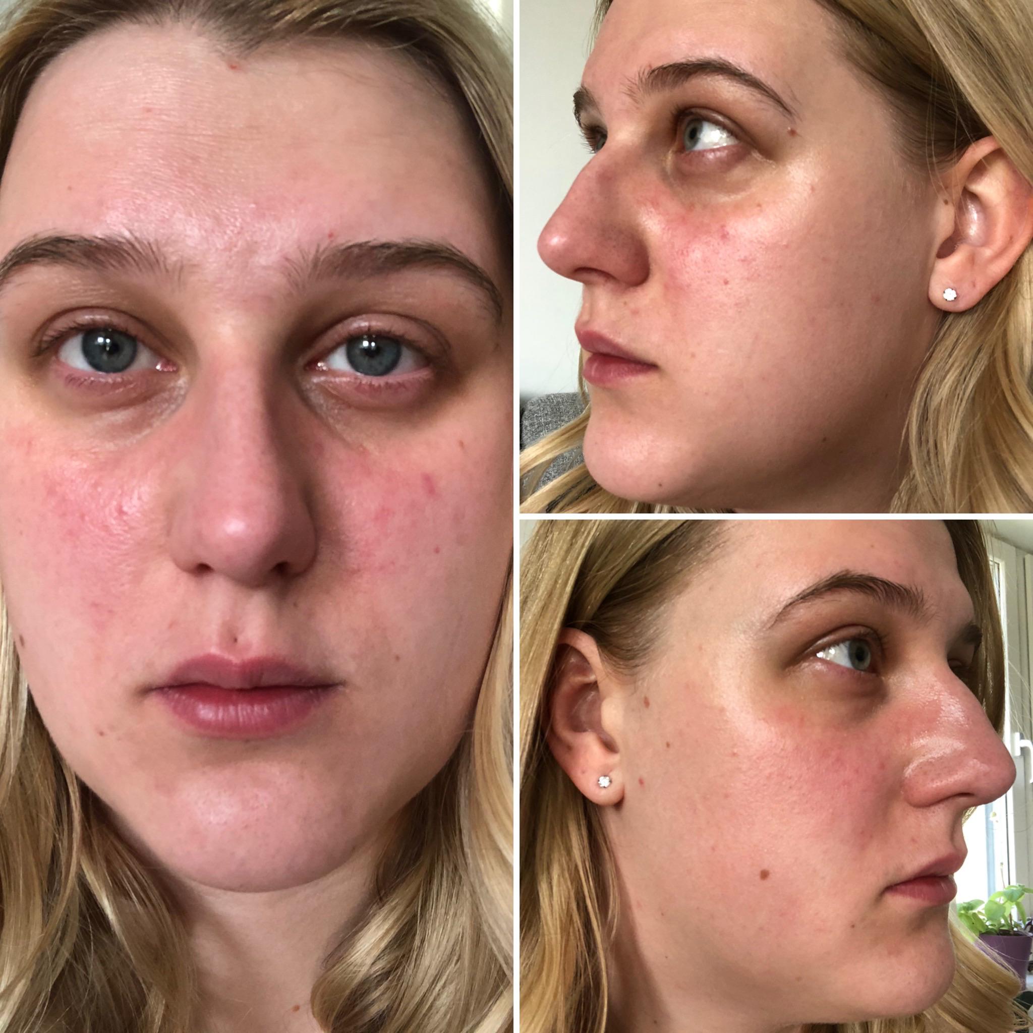 [skin concern] I have combination skin with dry cheeks, oily Tzone and