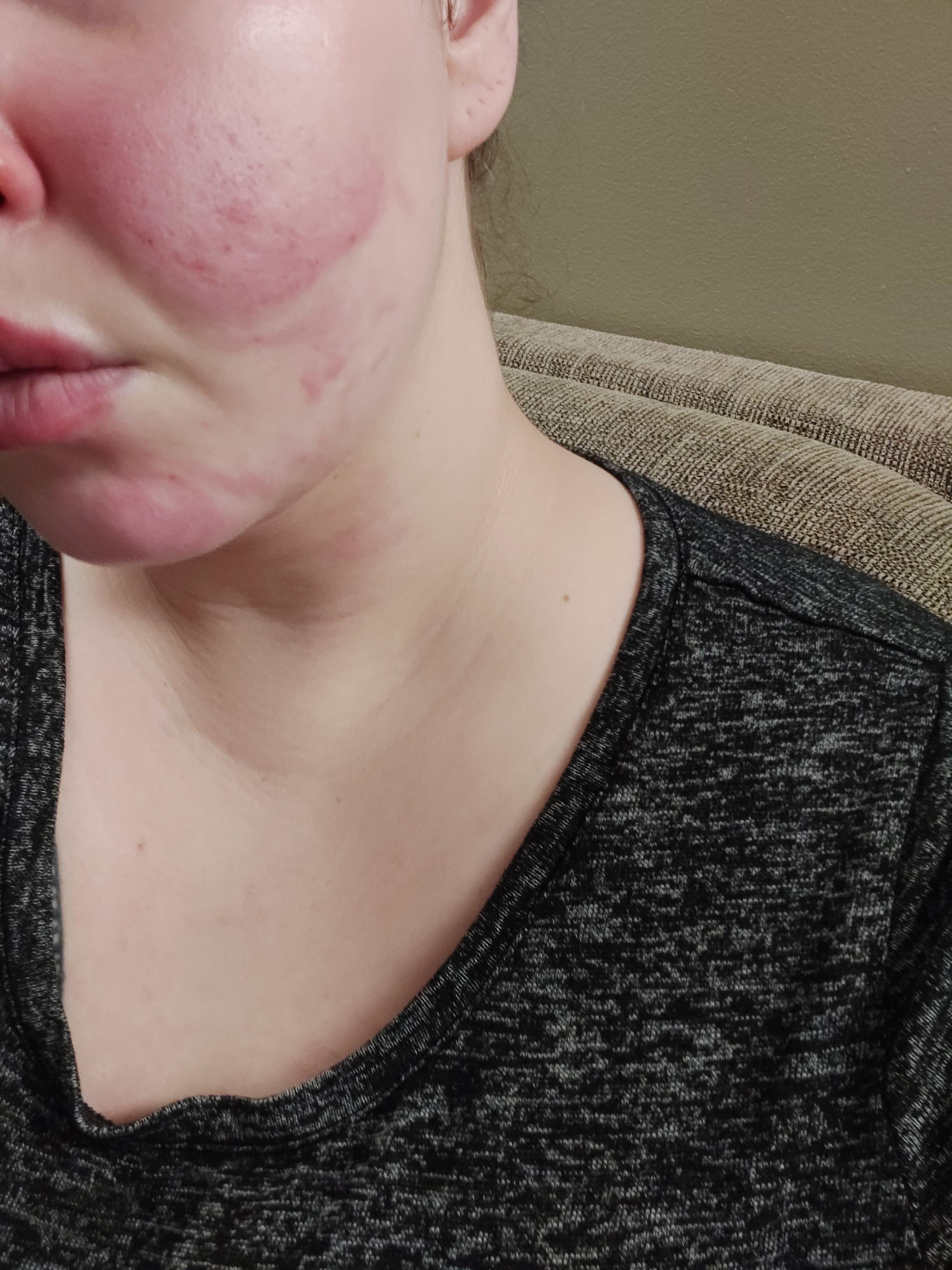 Just in case anyone wondered what an airbag does to a face.... my lip