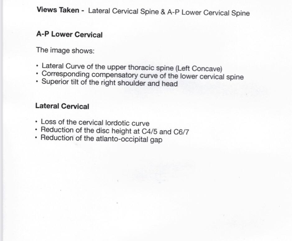 Posture is the suspected cause. Is it fixable? r/backpain