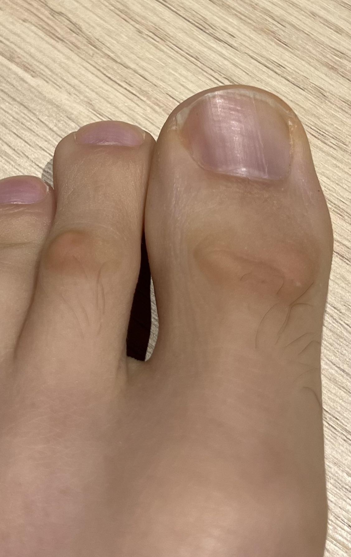 What is this spot on my big toe knuckle? Fungus, callus, or corn? r