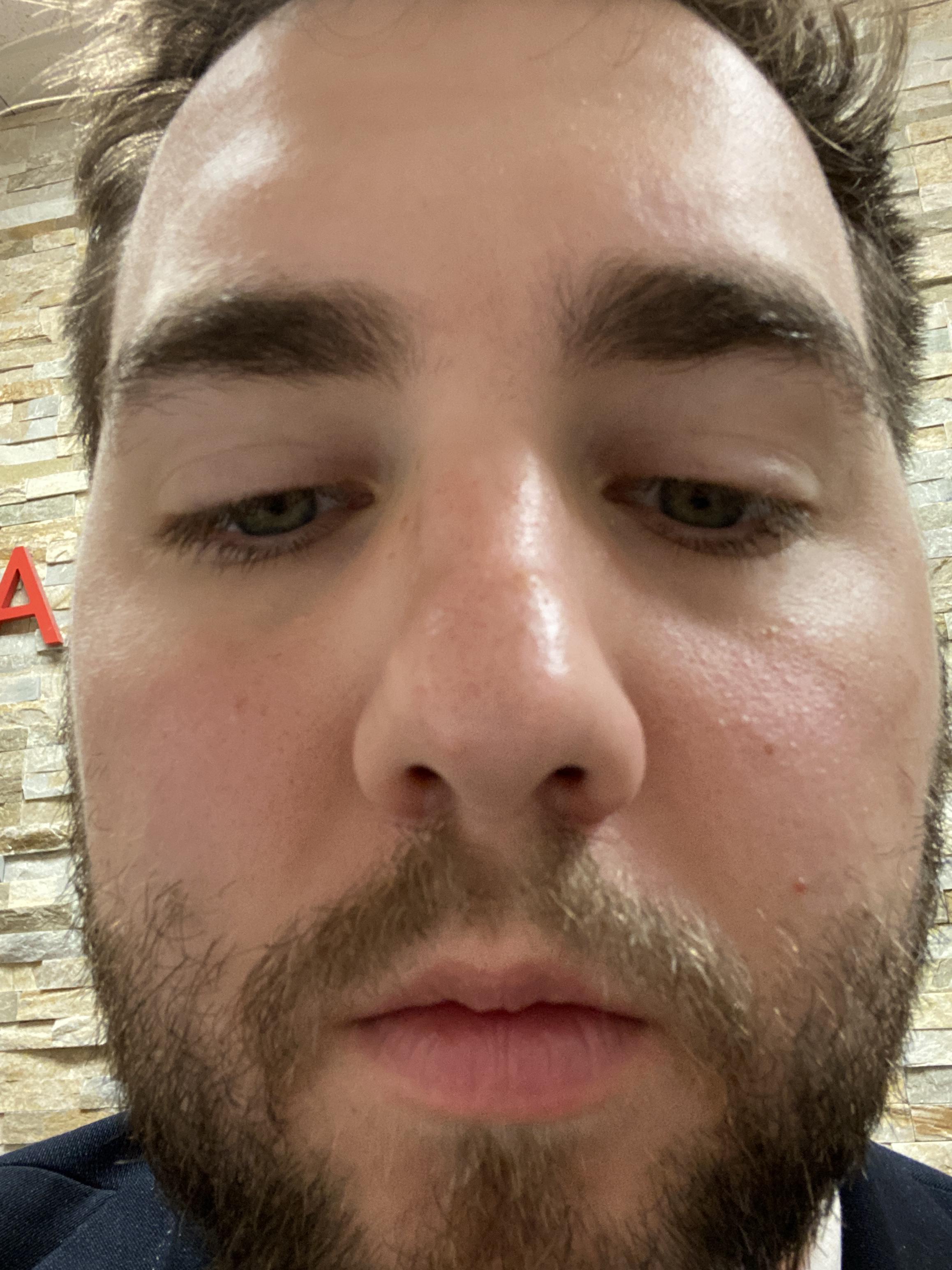 I don’t know what’s up with my nose r/DermatologyQuestions