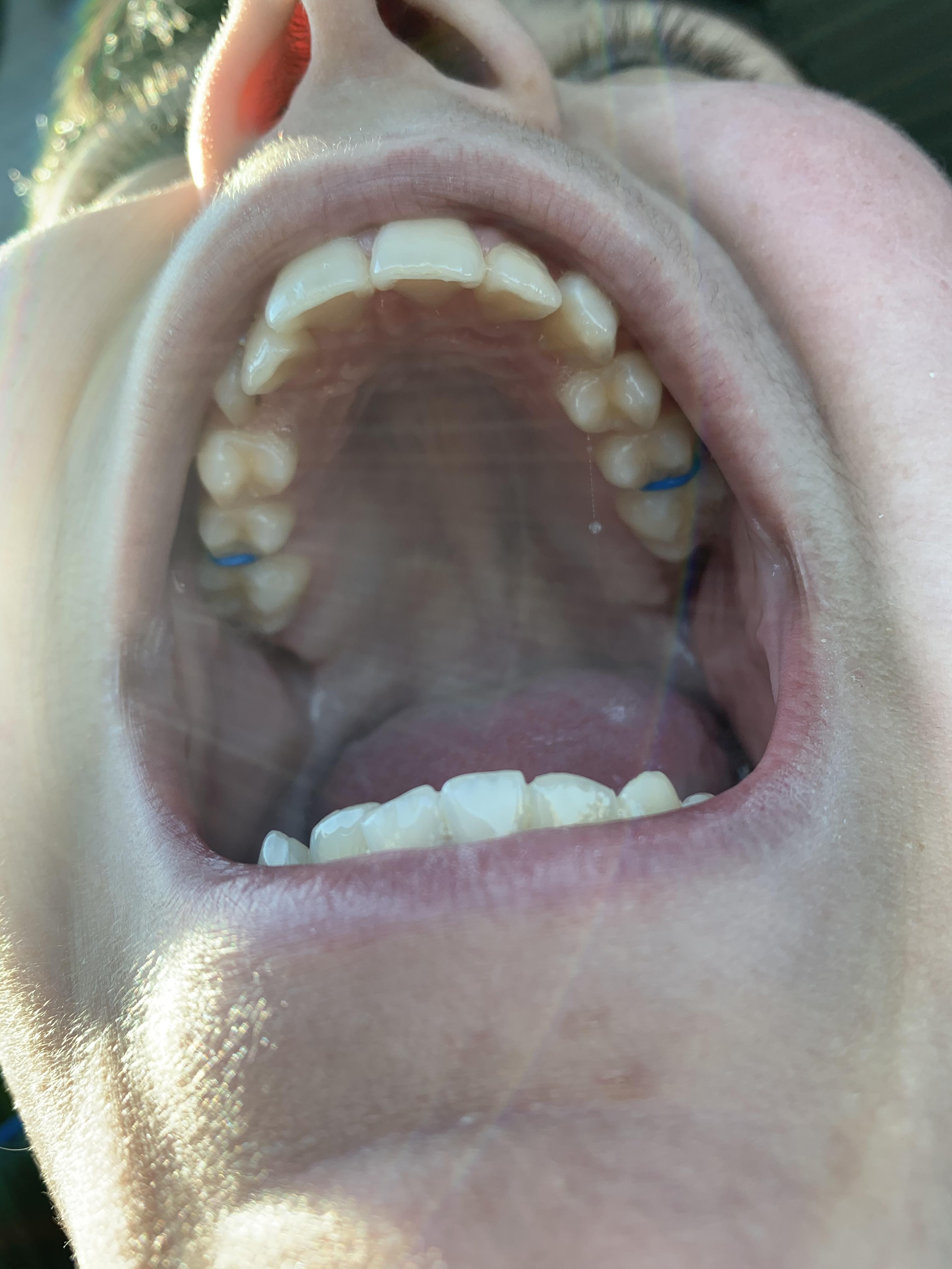 Spacers in. And getting braces on 2/25 for 22 months. Mostly due to my