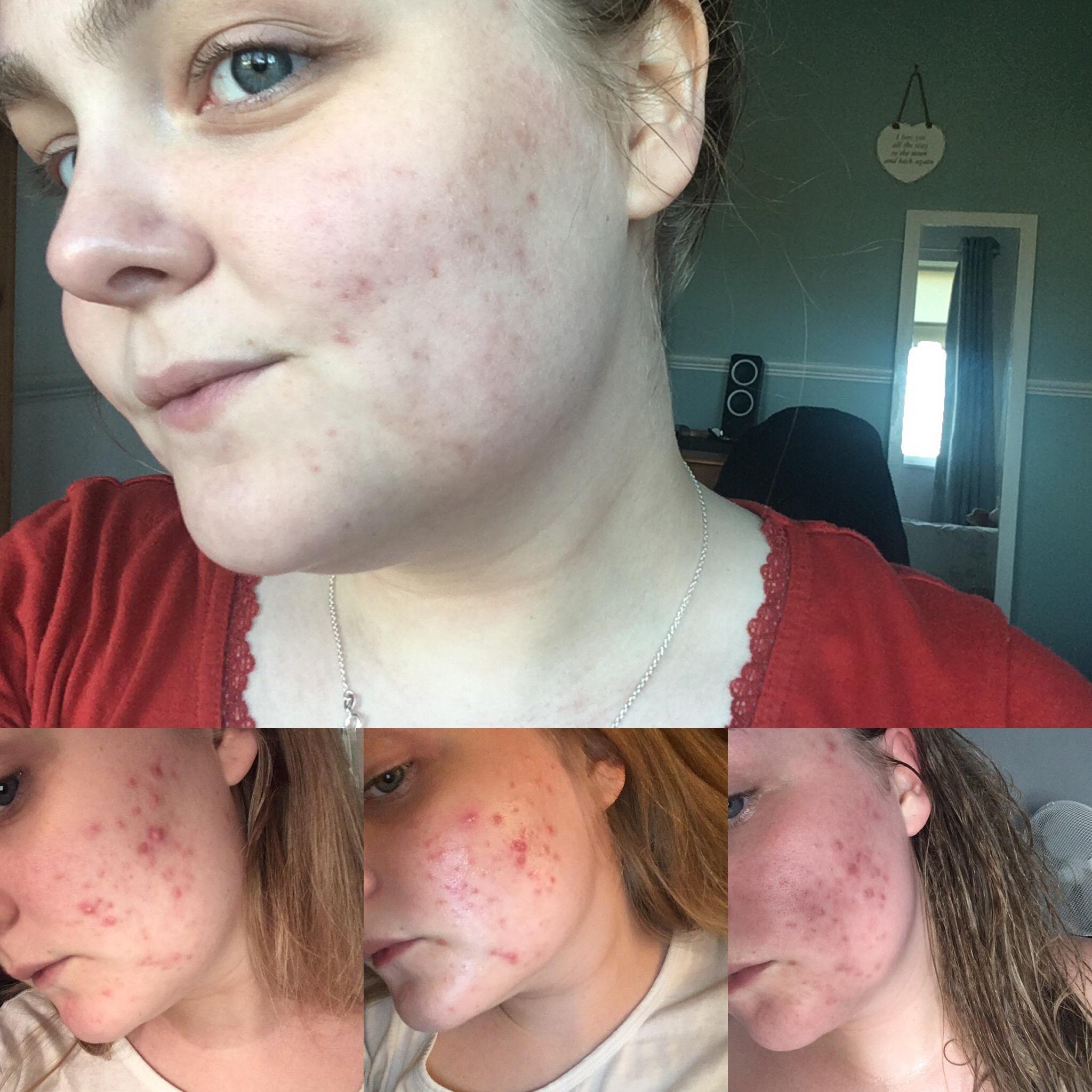 [Acne] People with acne scars, what have you found that helps? After