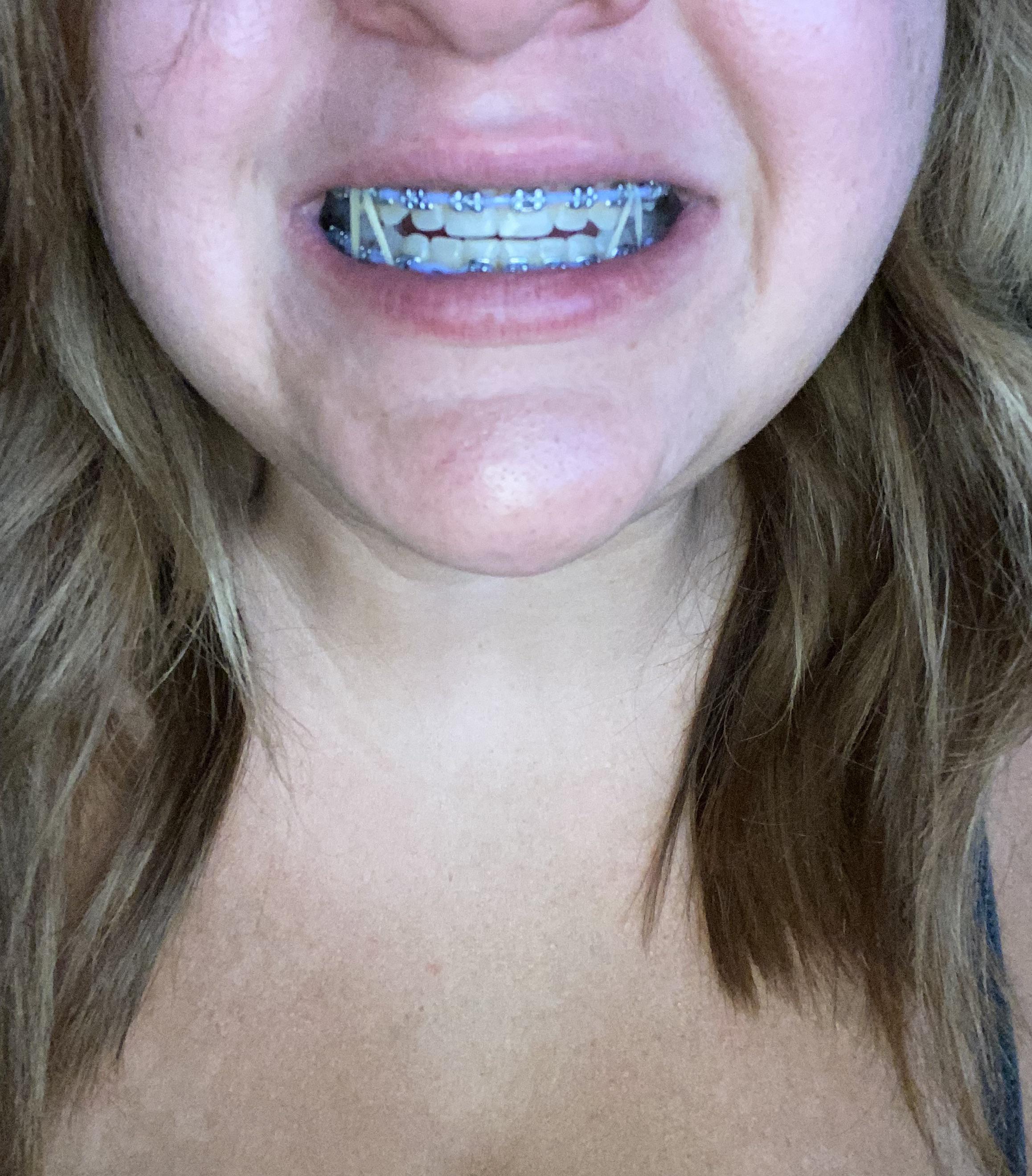 20 months on and I lost my first bracket eating ribs…I swallowed it. r/braces