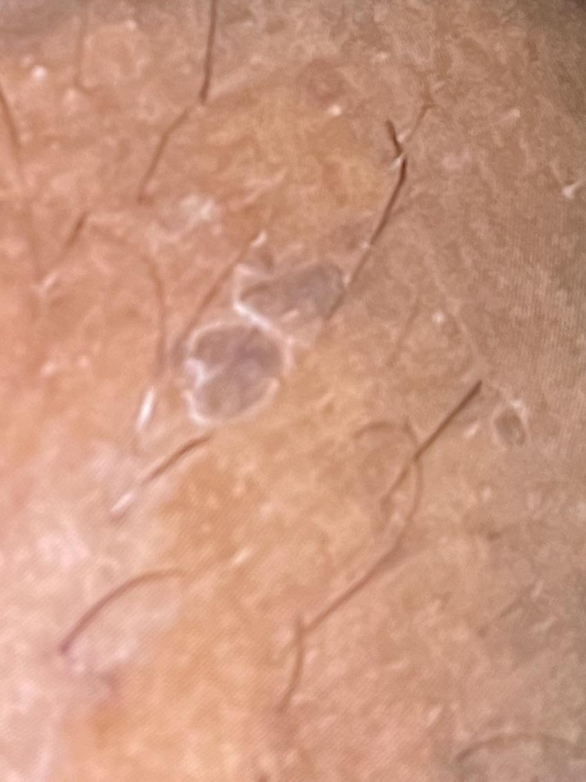 Does this look like genital warts or just a scab over a friction burn