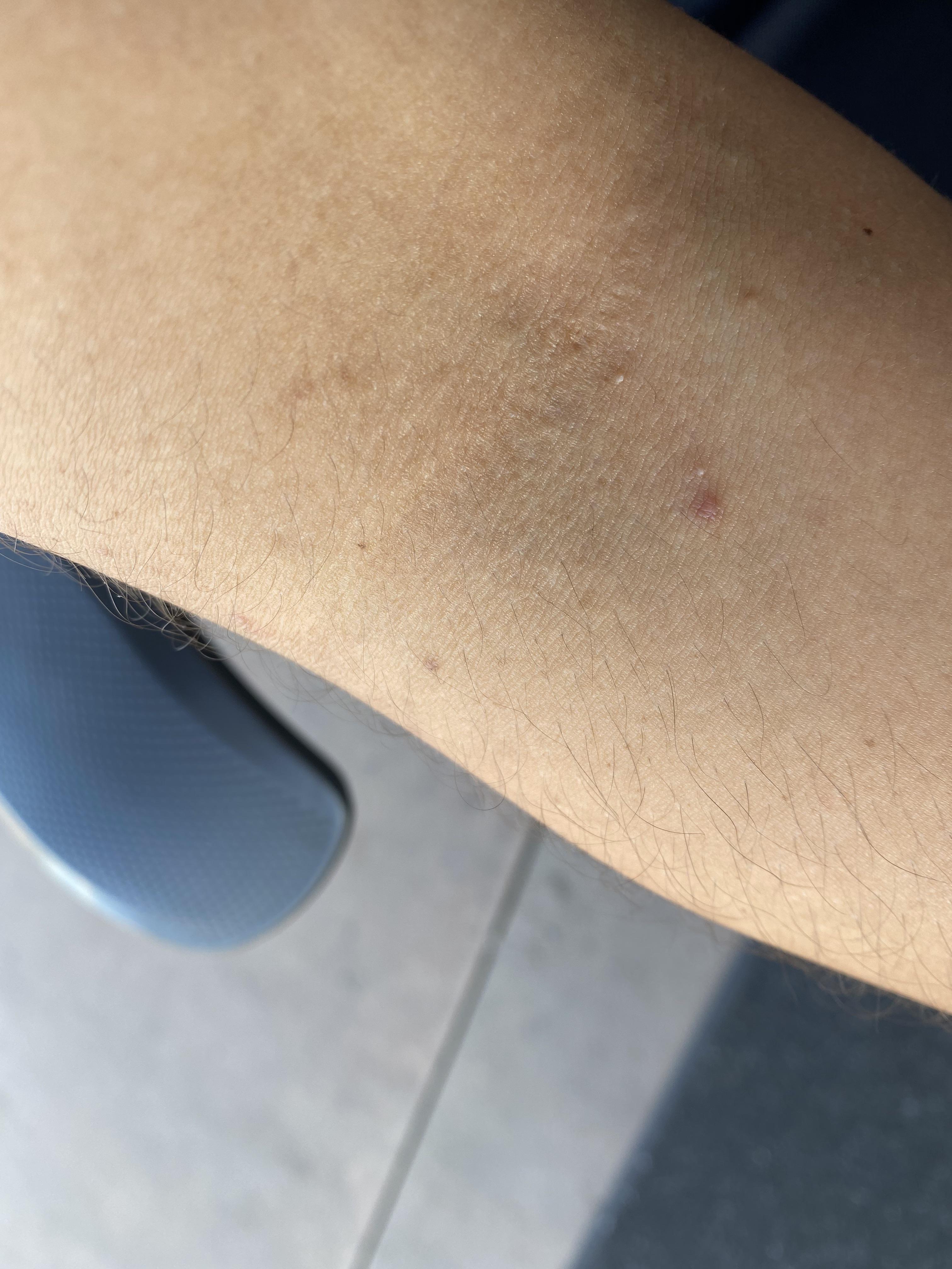 What are these white bumps? I keep getting them along my elbows and the