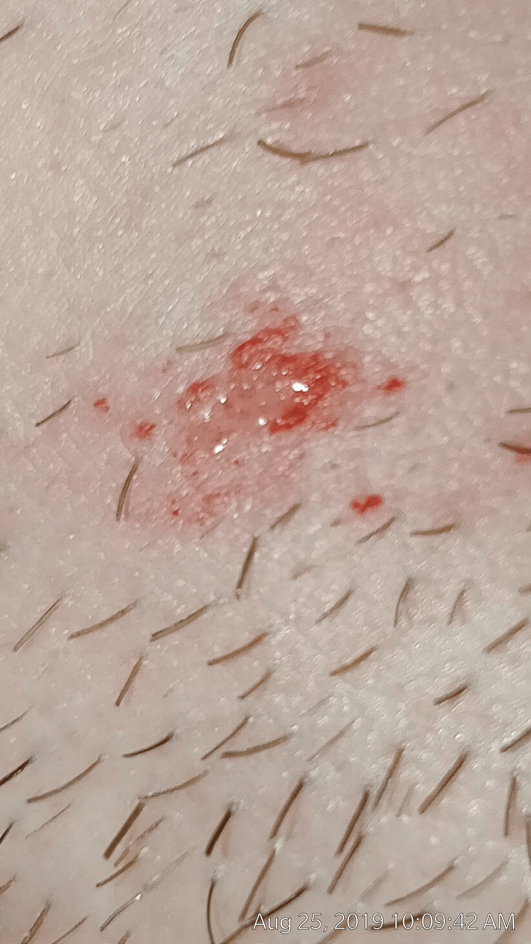 Is this a heat rash? Its the only area on my face that looks like it