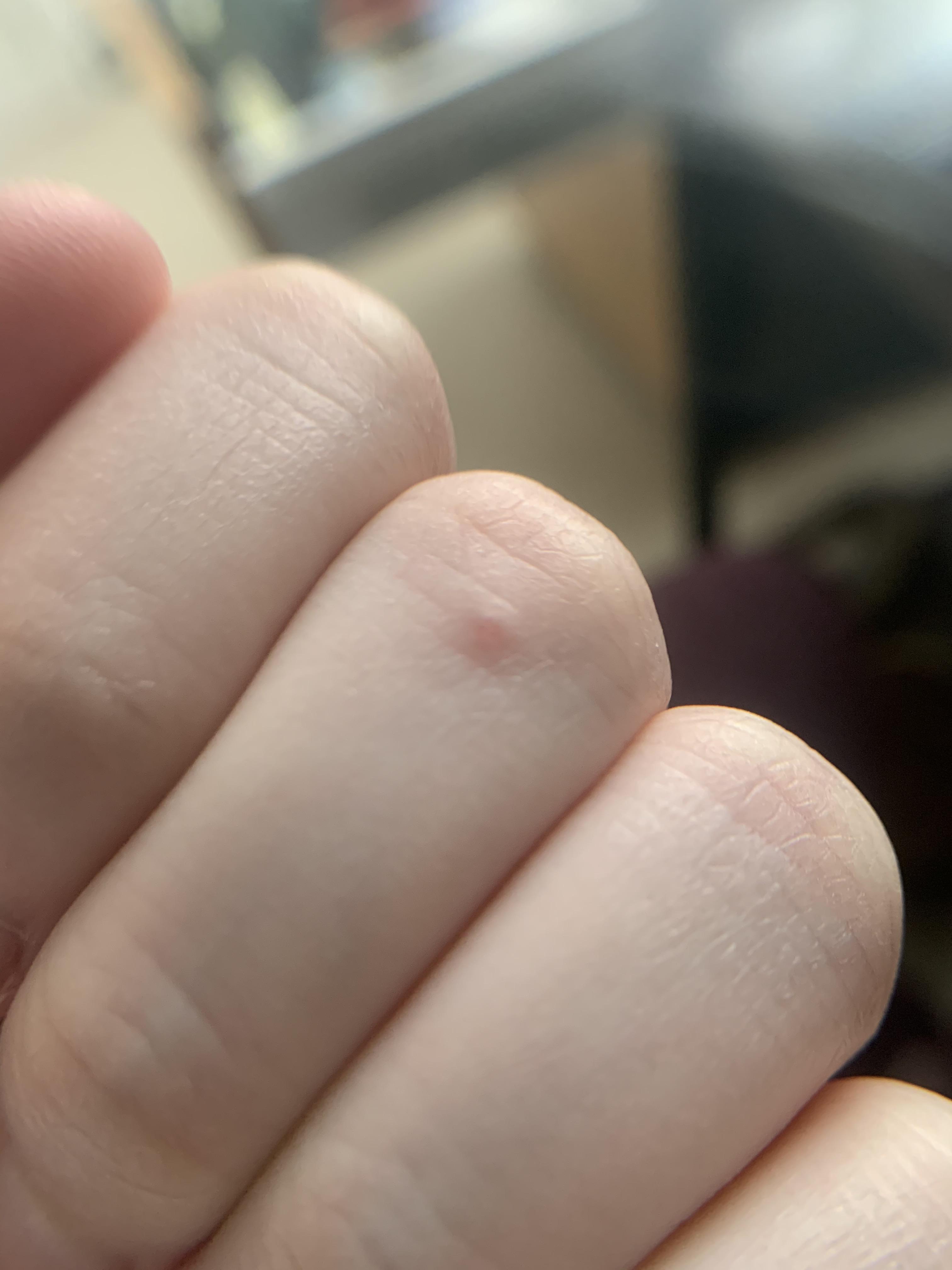 Tiny raised pink/red bump on knuckle, been there for year+. Never
