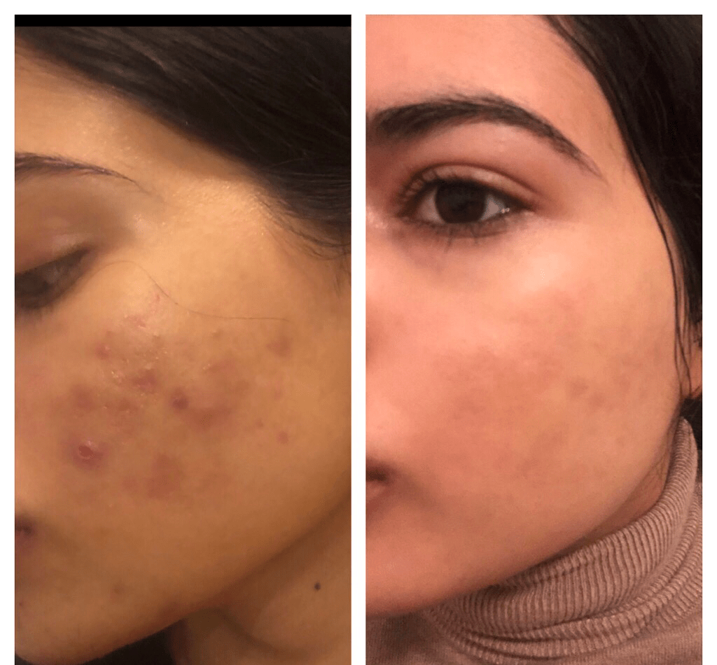 List 91+ Background Images Before And After Accutane Side Effects Updated