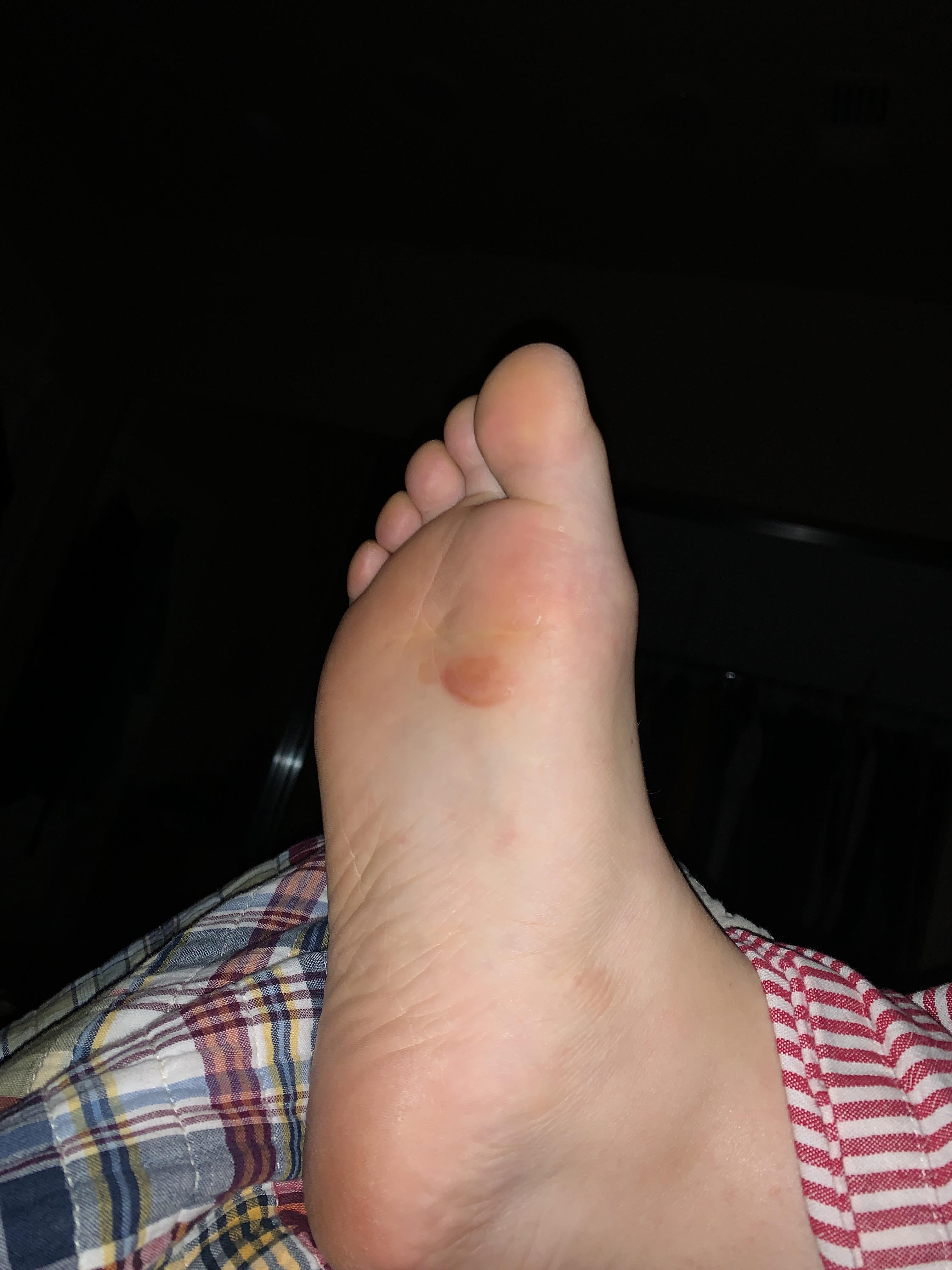 Blisters on balls of feet. Run in Vrun. Can do a form check video to