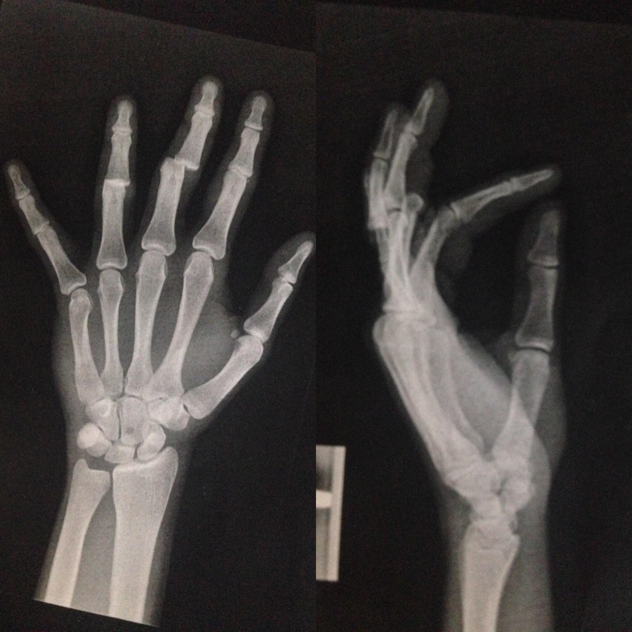 Double finger dislocation (middle & ring) and small fracture on index