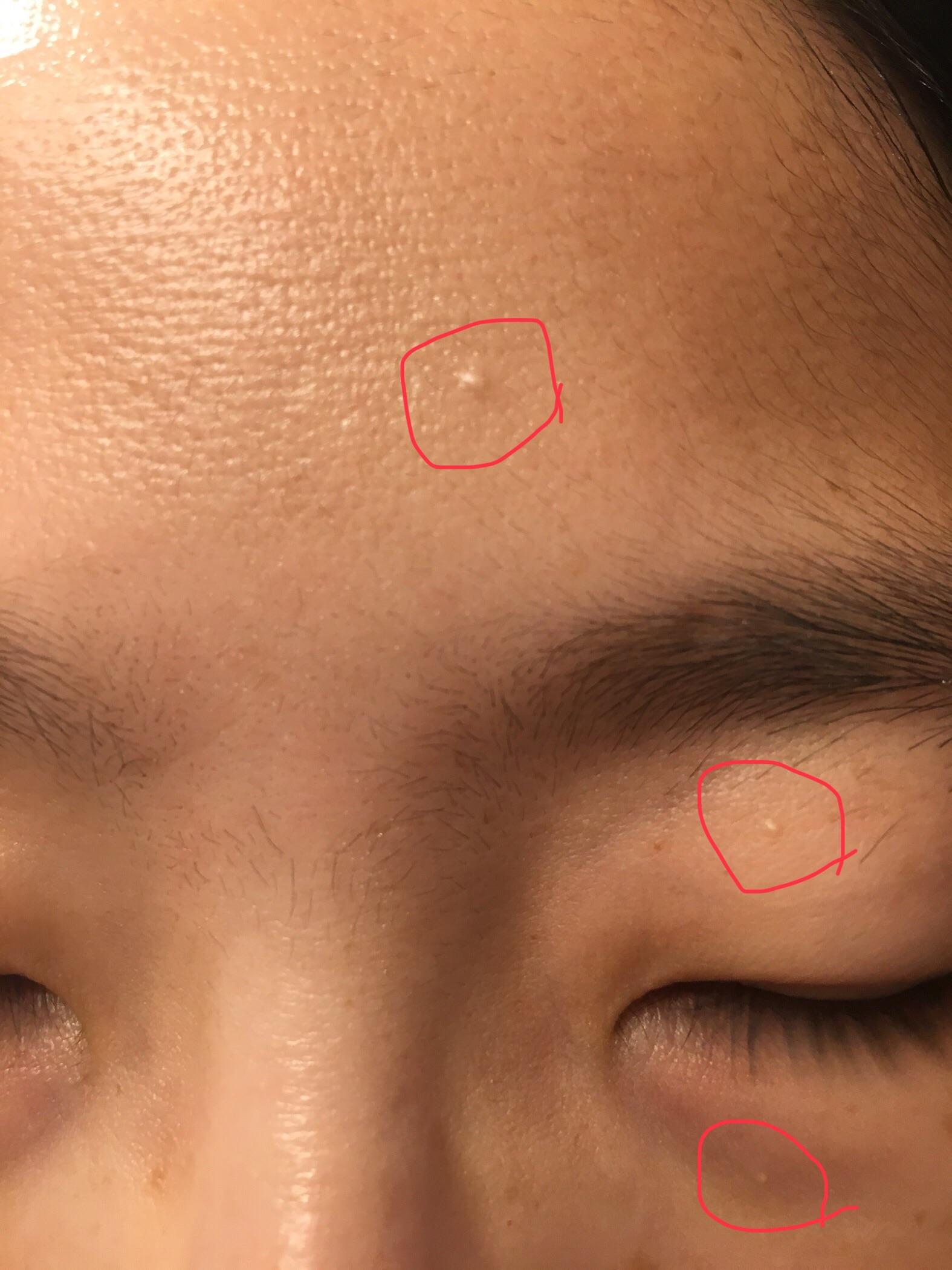 Milia Forehead
