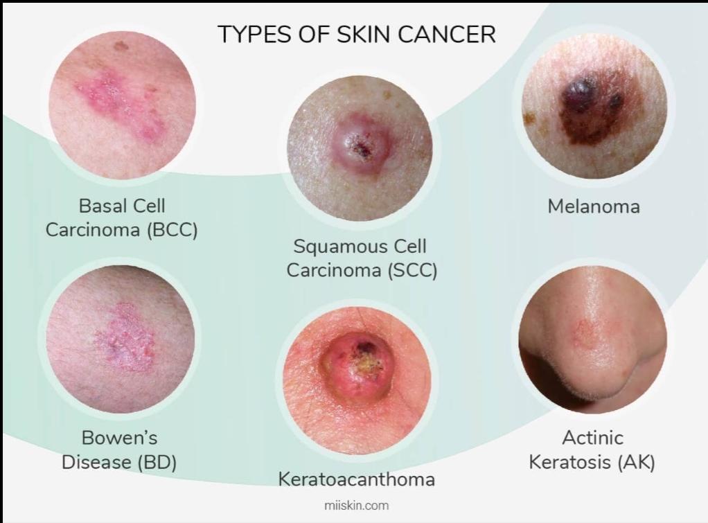 When not to pop a quick skin cancer PSA (details in comments) r