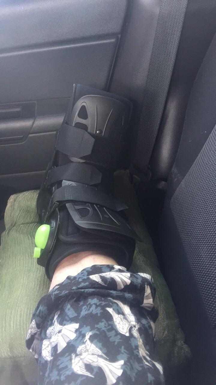 5th Metatarsal, Jones fracture. First bone I’ve ever broken. But at