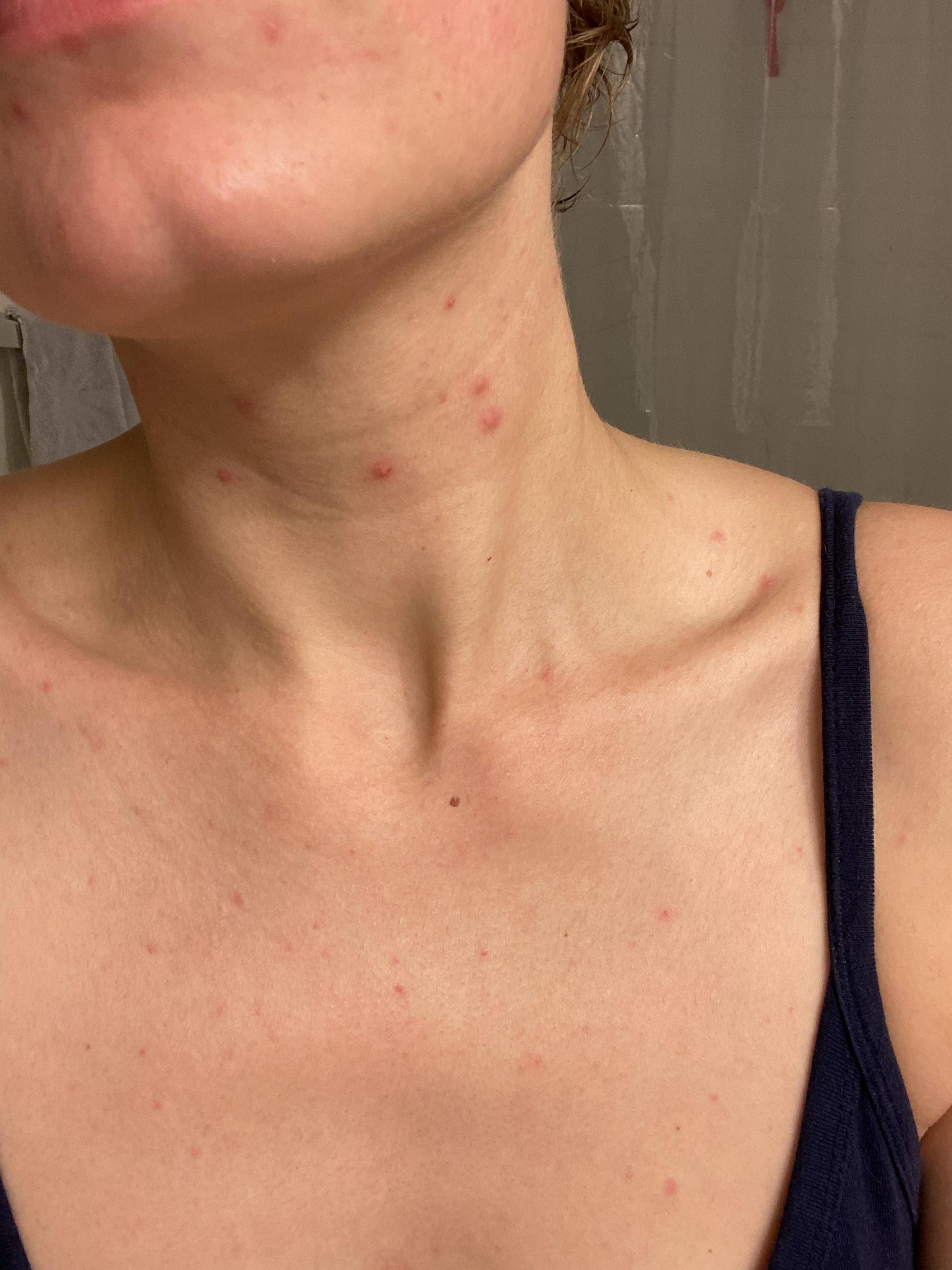[Acne] I’ve started getting pimples on my neck and I can’t figure out
