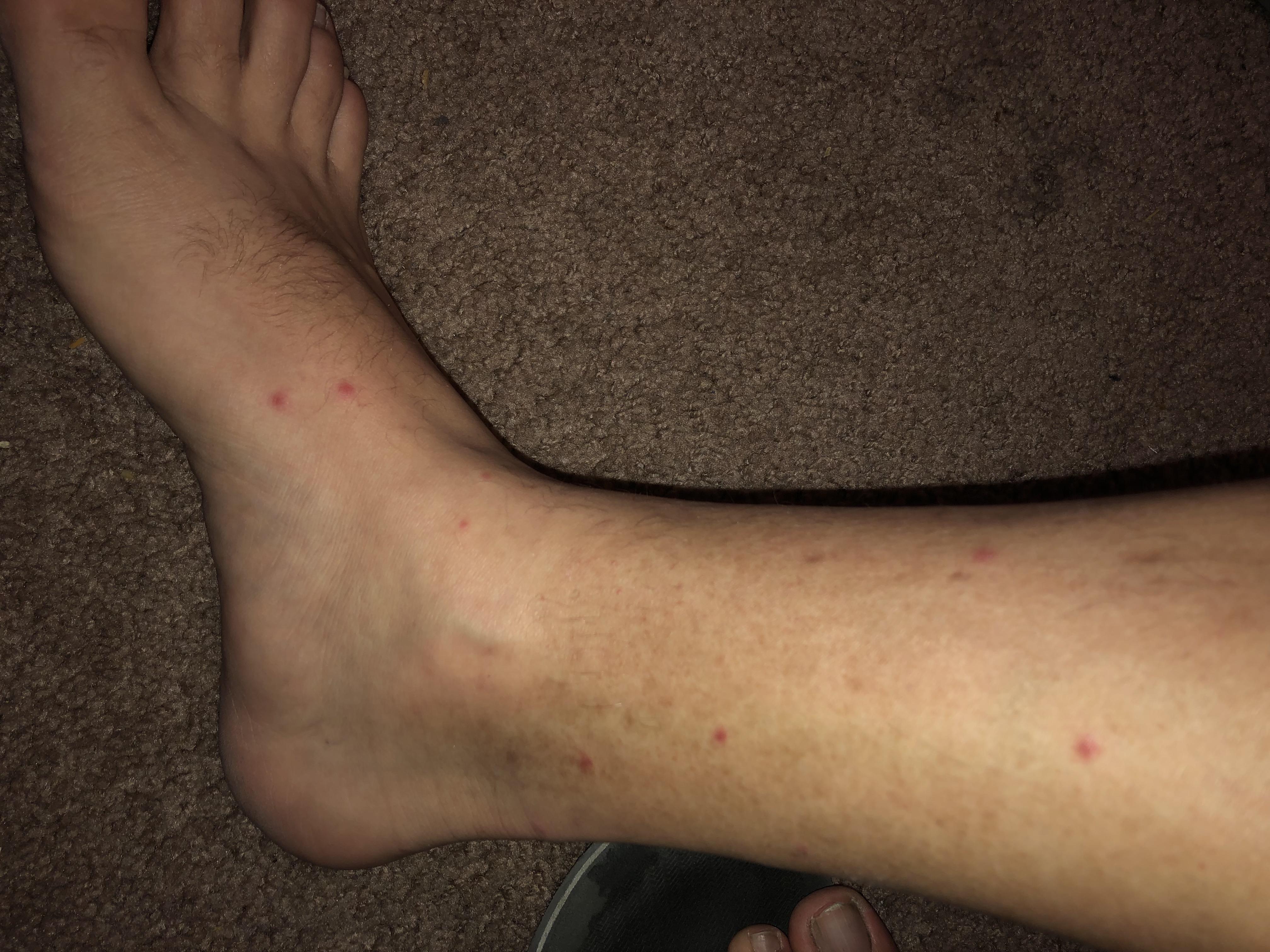 These red bumps on my calves and feet don’t hurt or itch. They show up