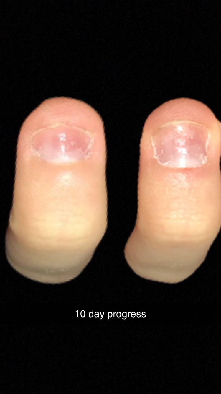 This is literally 10 days in. This is my middle finger on my right hand