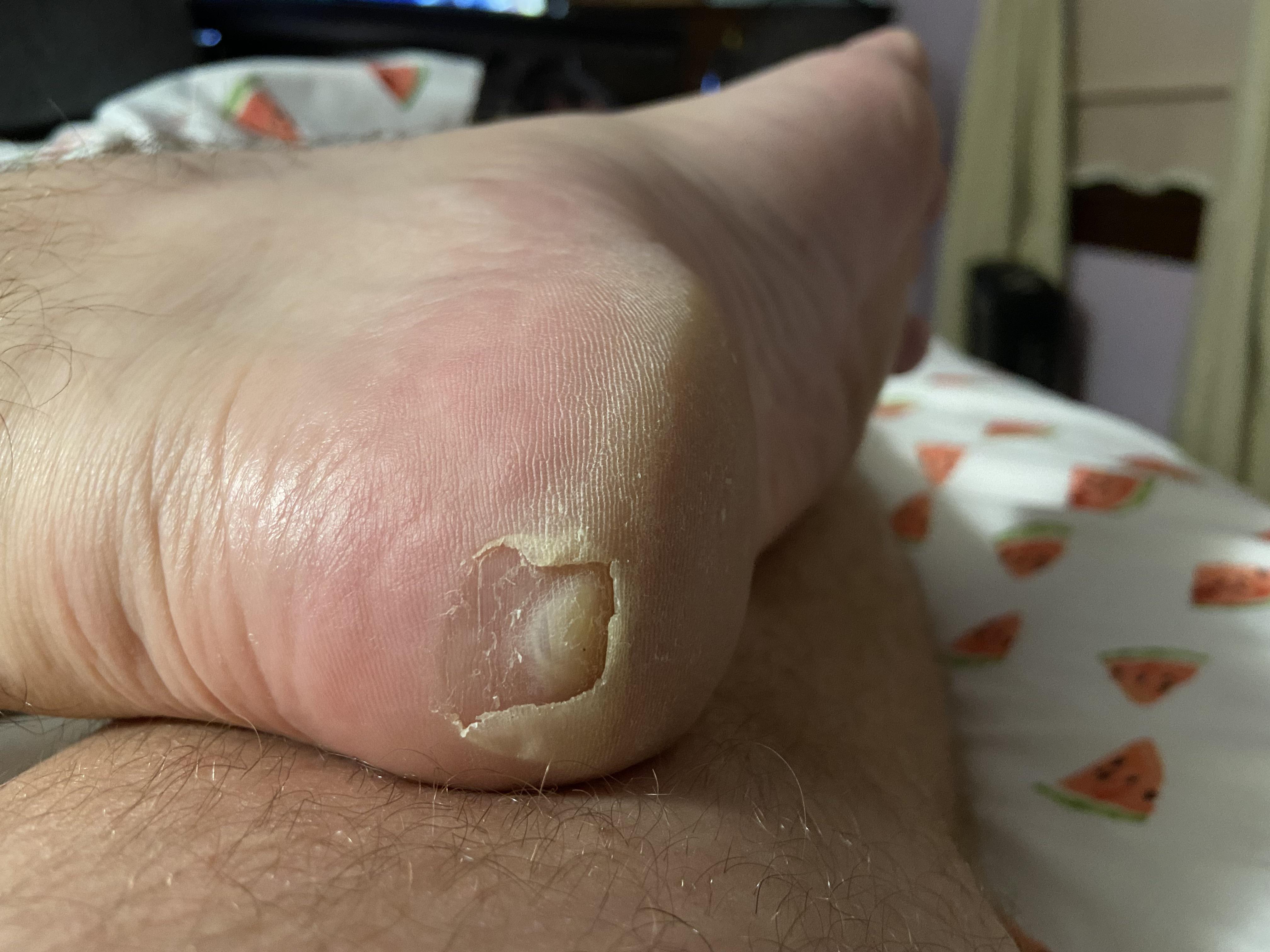 Forbidden pop blisterwithinablister r/popping
