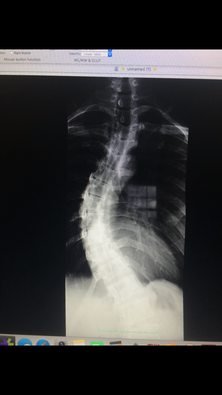 Scoliosis causing chest pain scoliosis