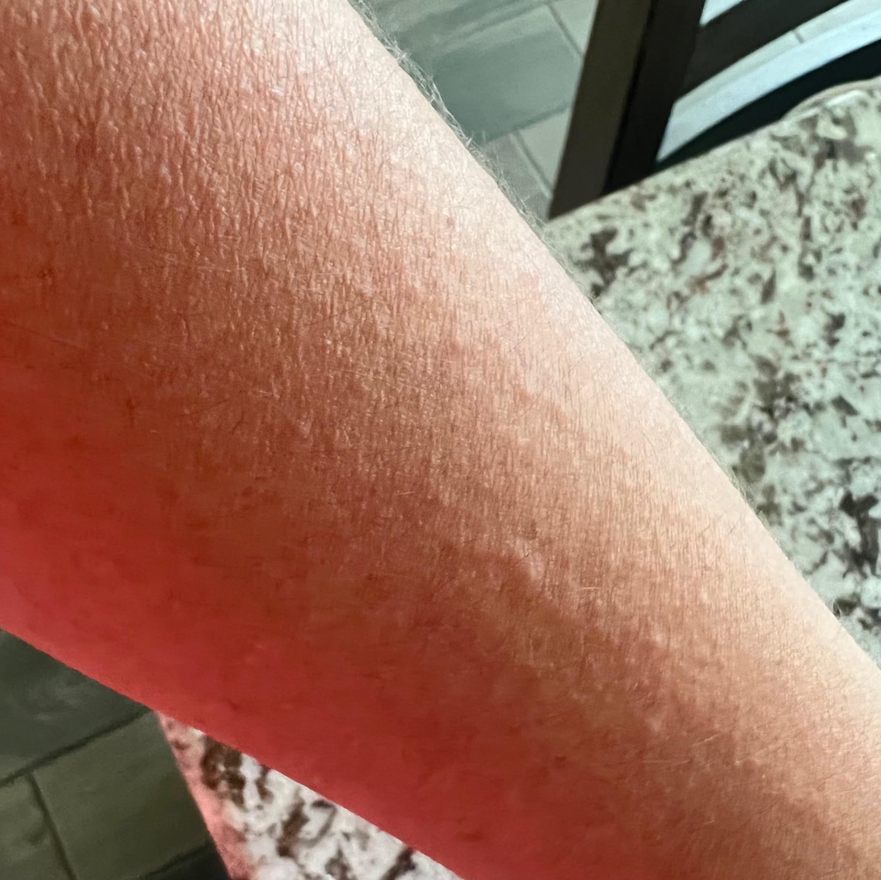 New, small itchy bumps on both forearms that have appeared over the