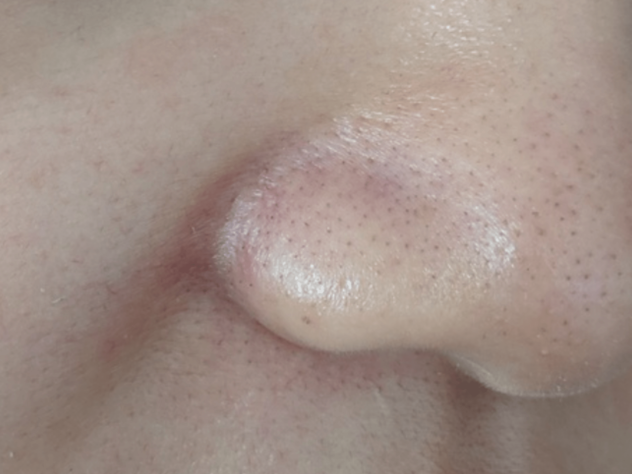 [Routine Help] Dark around nose (not the sebaceous filaments) r