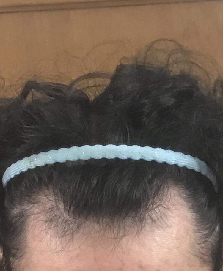I've noticed a ton of "baby hairs" after 2 months of rogaine for