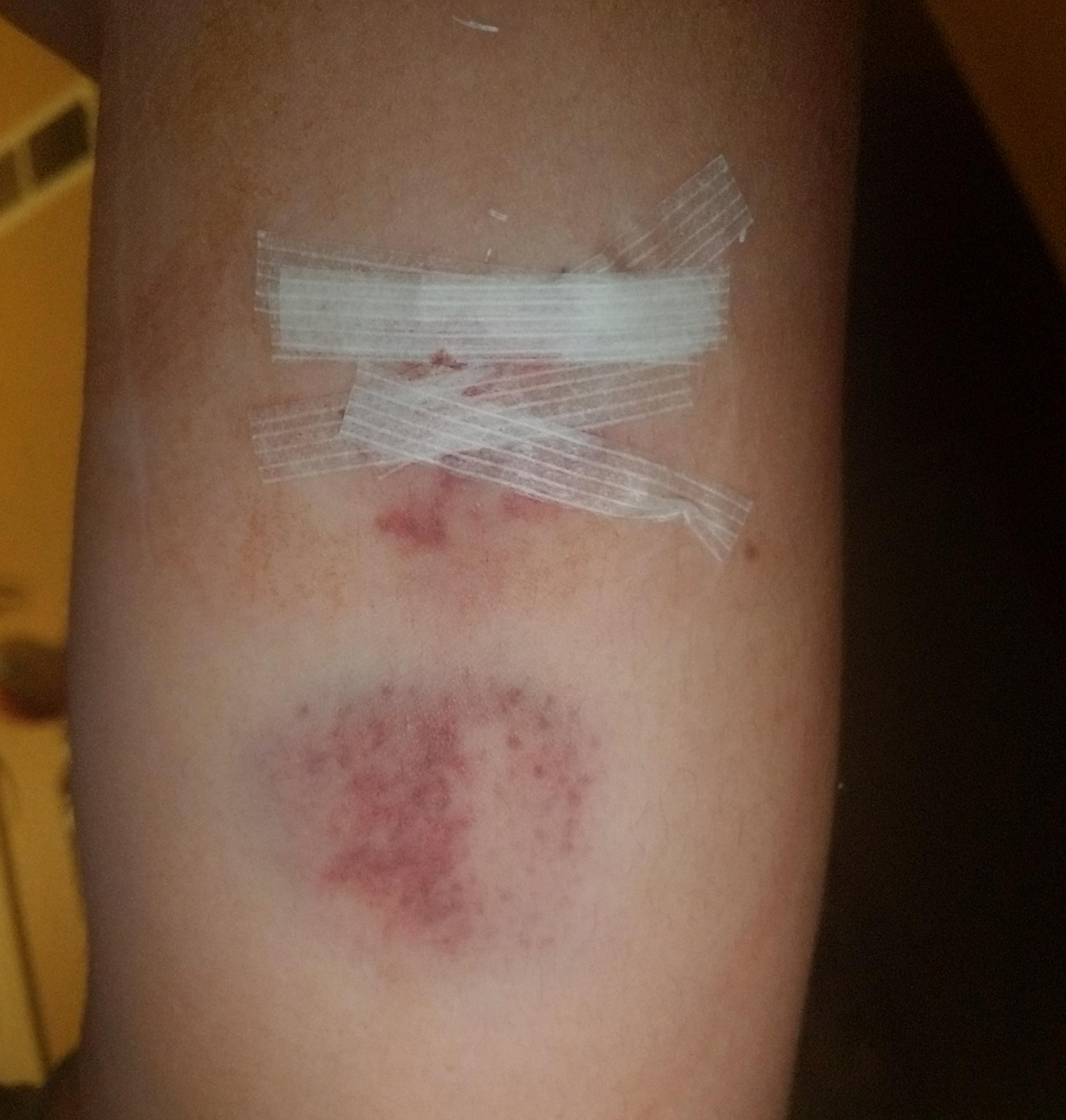 Switched from Depo to Nexplanon today. Procedure was easy and quick