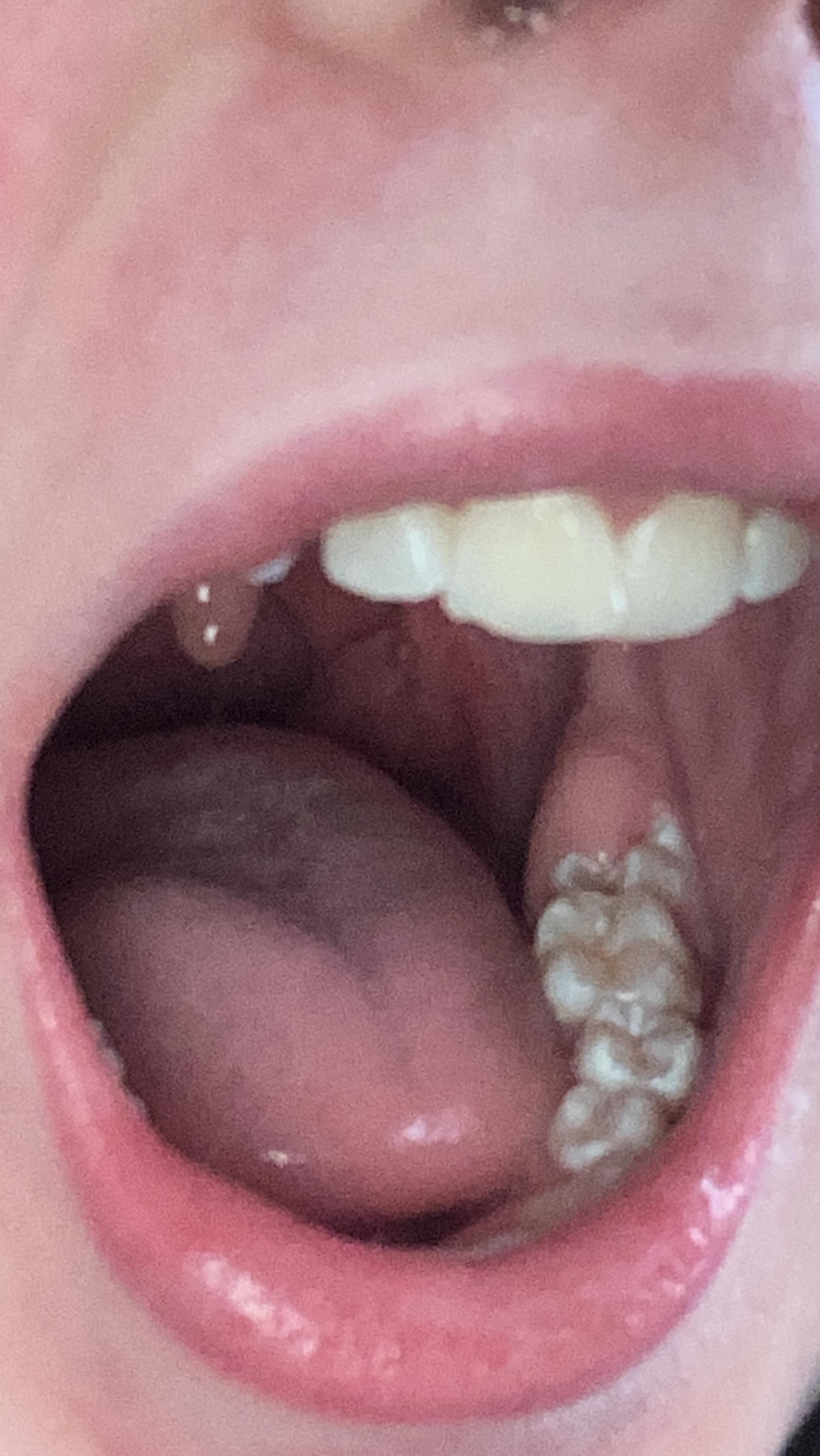 lump near my wisdom tooth (?) only just noticed that my wisdom tooth