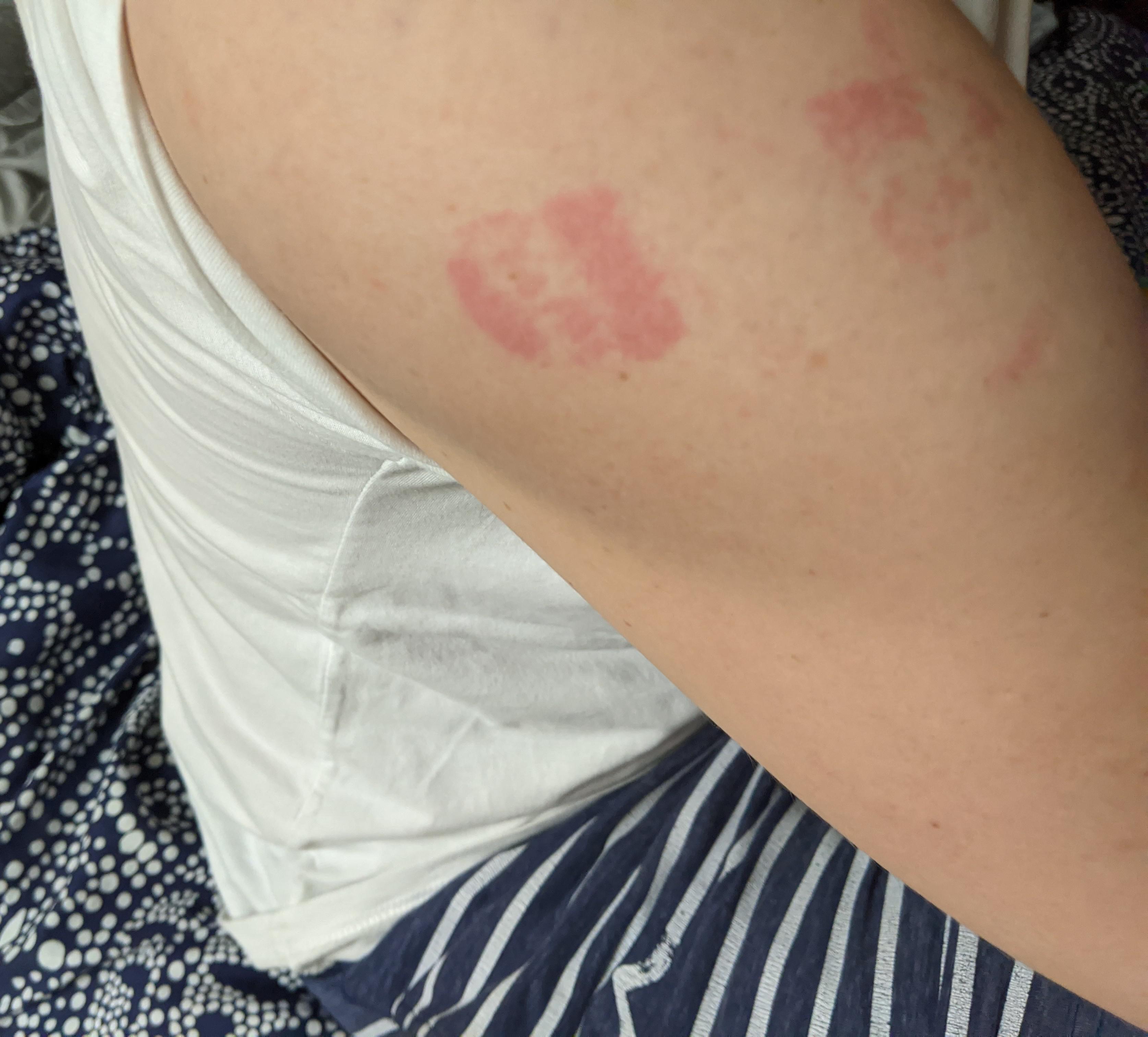 Dave Stukus On X Rashes From Bandaids Are Very Common, 44 OFF