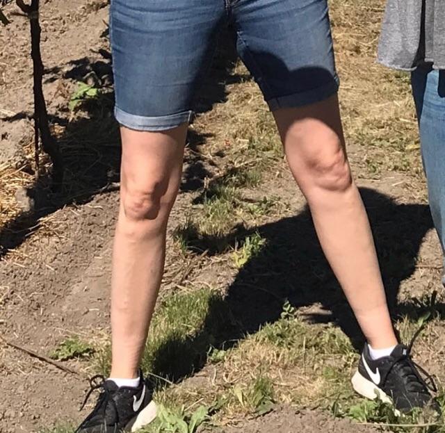 Double Knee faces r/babyfaceknees