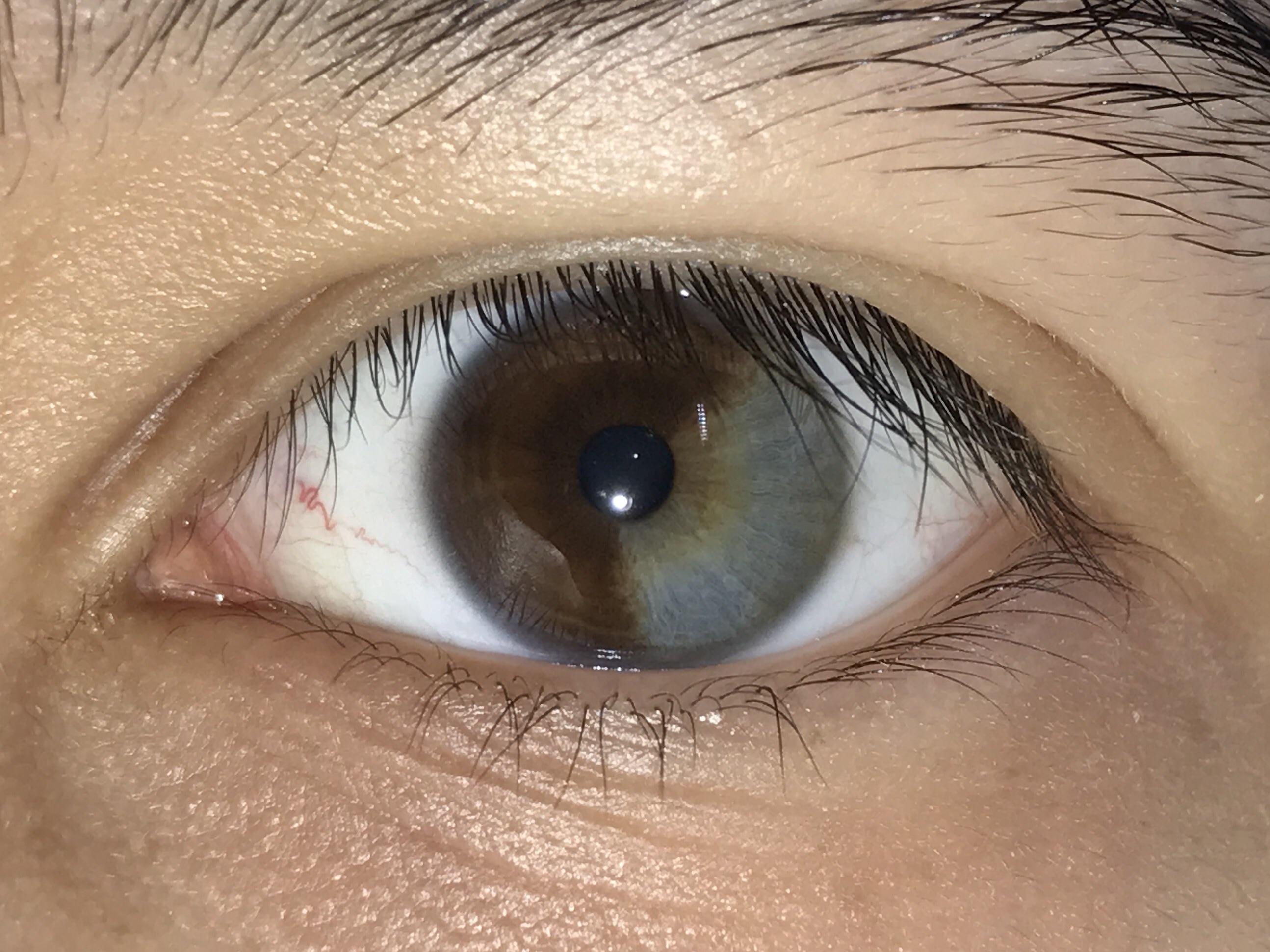 My left eye is about 1/3 grey mildlyinteresting