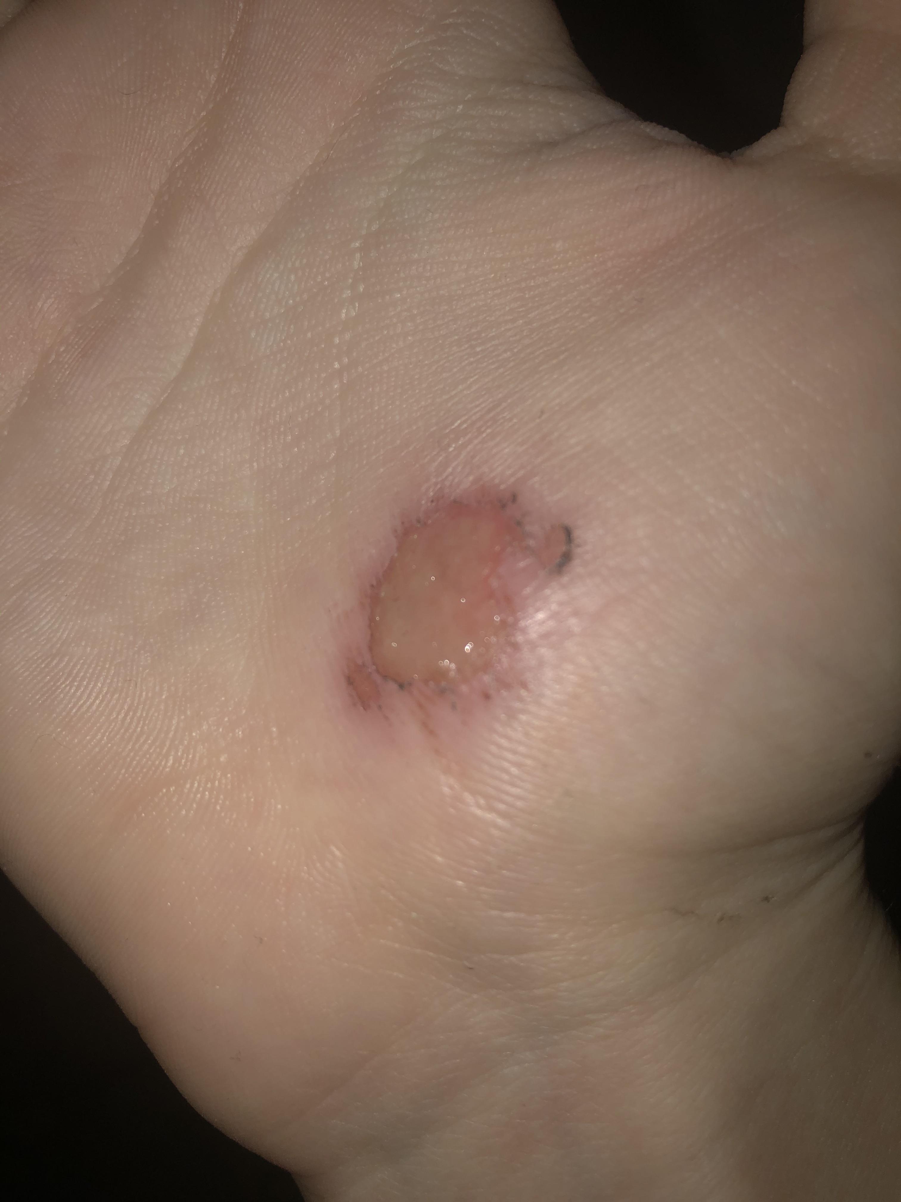 A yellowish wet layer has formed over a scrape wound. Is that normal